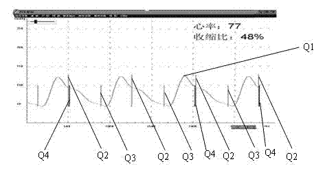 Haemodynamics-based forecast self-adaptive injection device