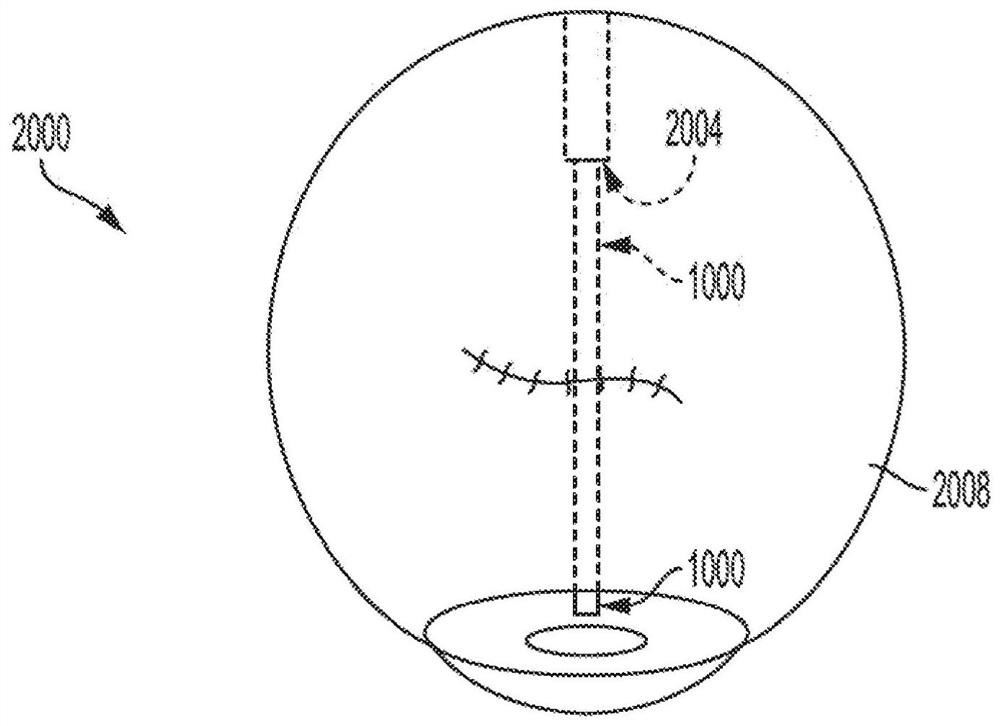 Ocular drainage system devices and methods