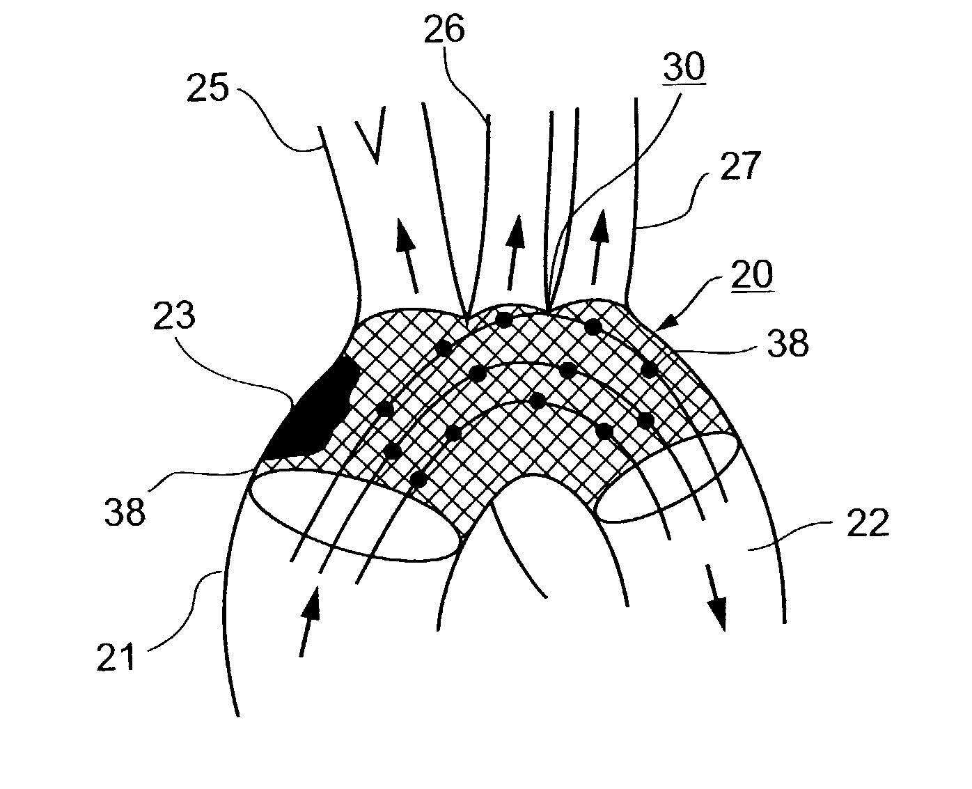 Implantable intraluminal protector device and method of using same for stabilizing atheromas