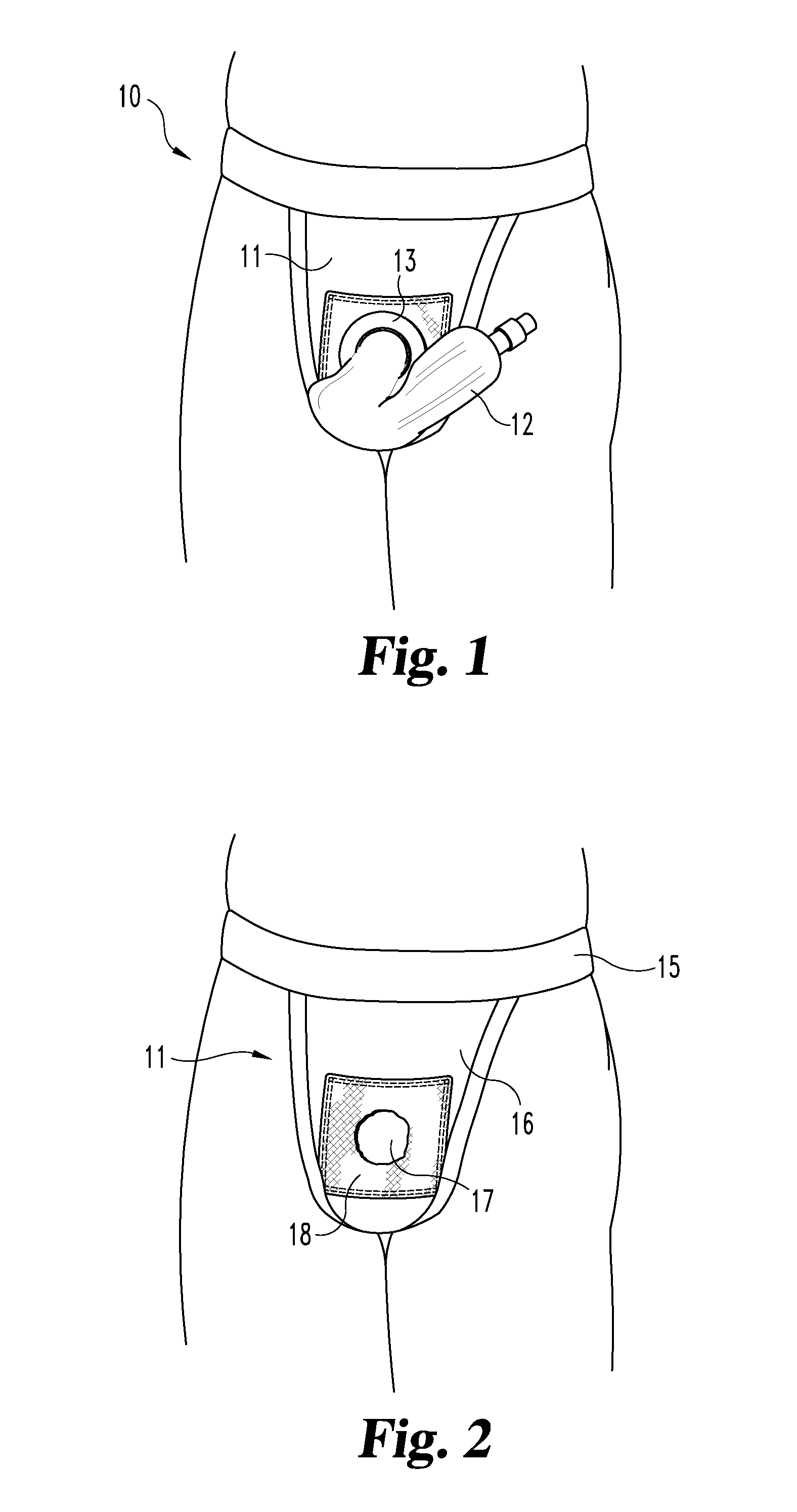 Device for supporting an ex-dwelling catheter
