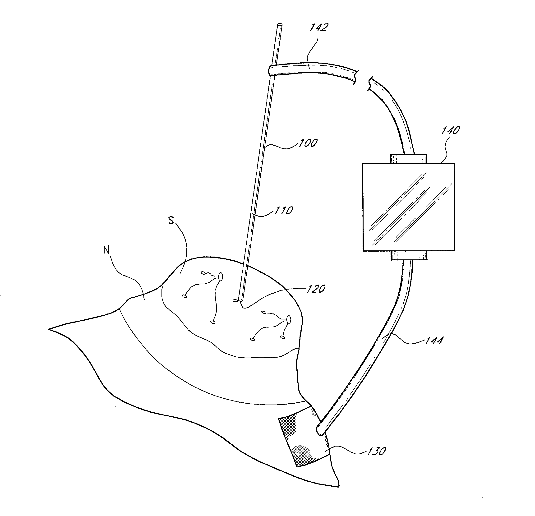 Device and method for accessing and treating ducts of mammary glands