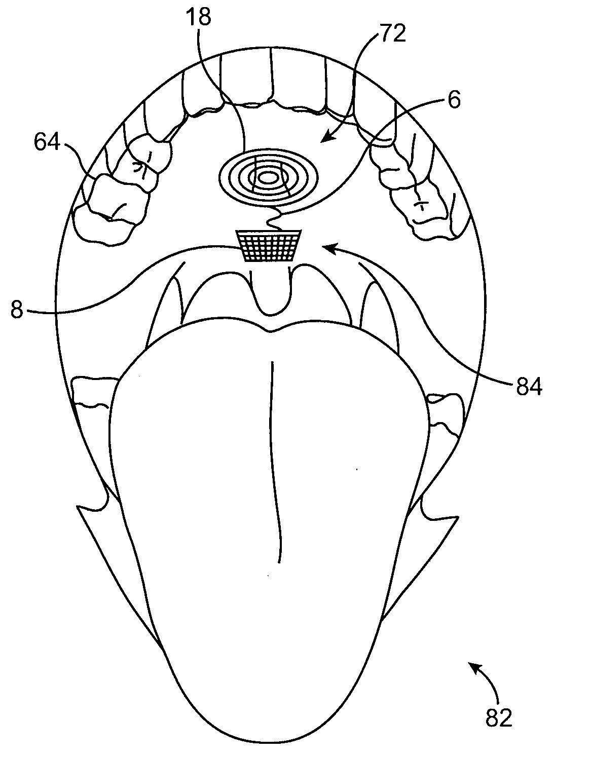 Inductive power transfer system for palatal implant