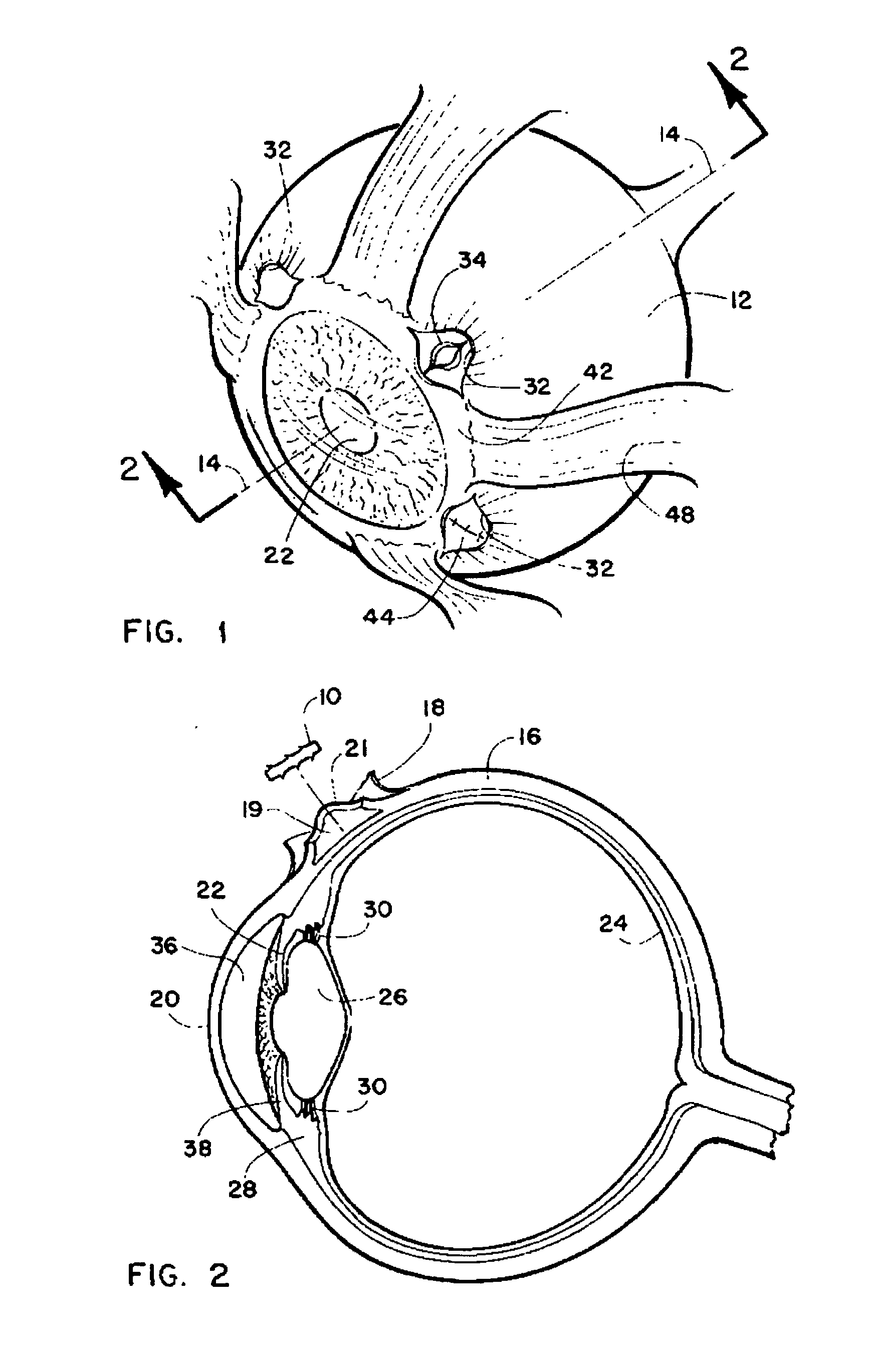 Method and intra sclera implant for treatment of glaucoma and presbyopia