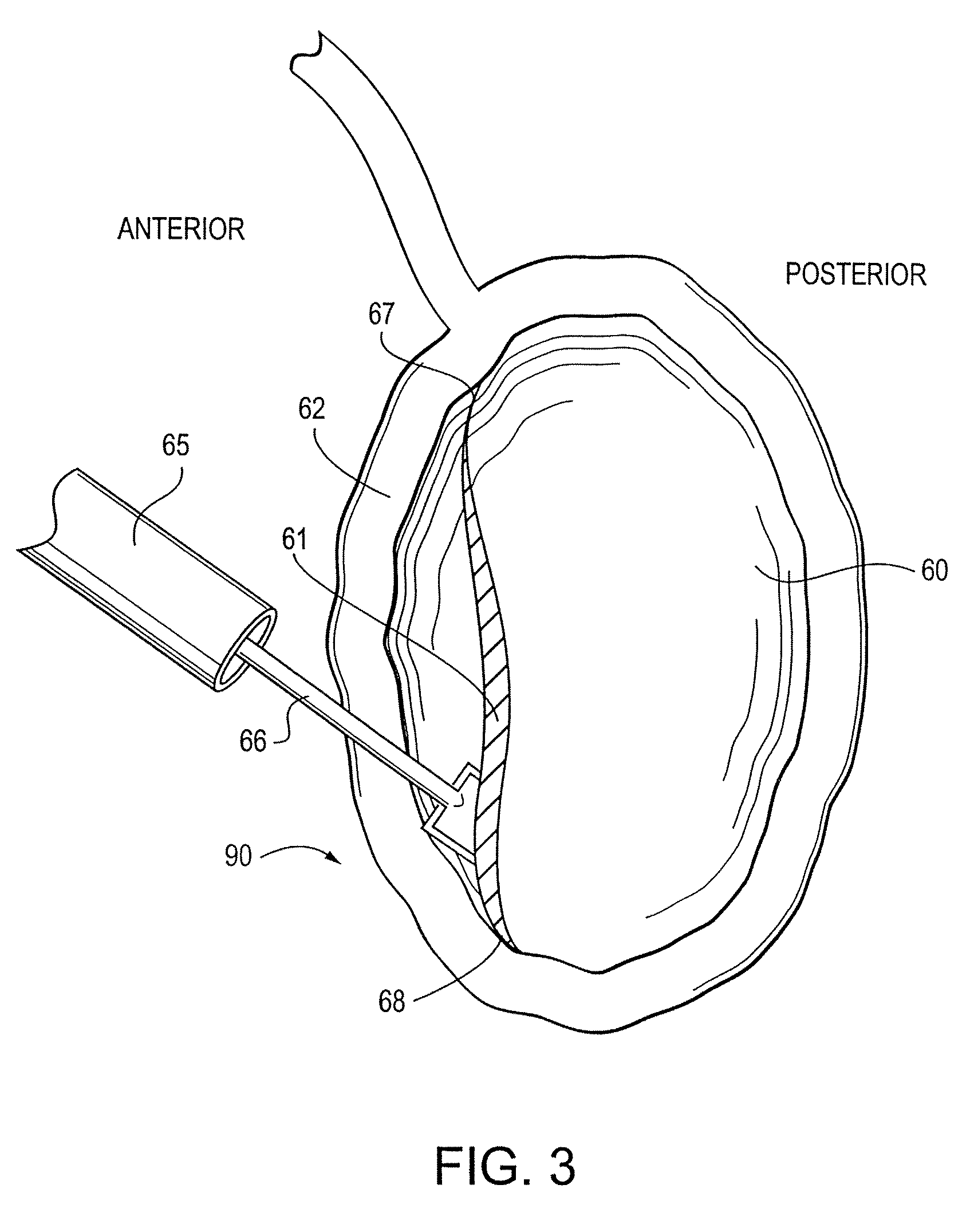 Offset drill guide and arthroscopic method