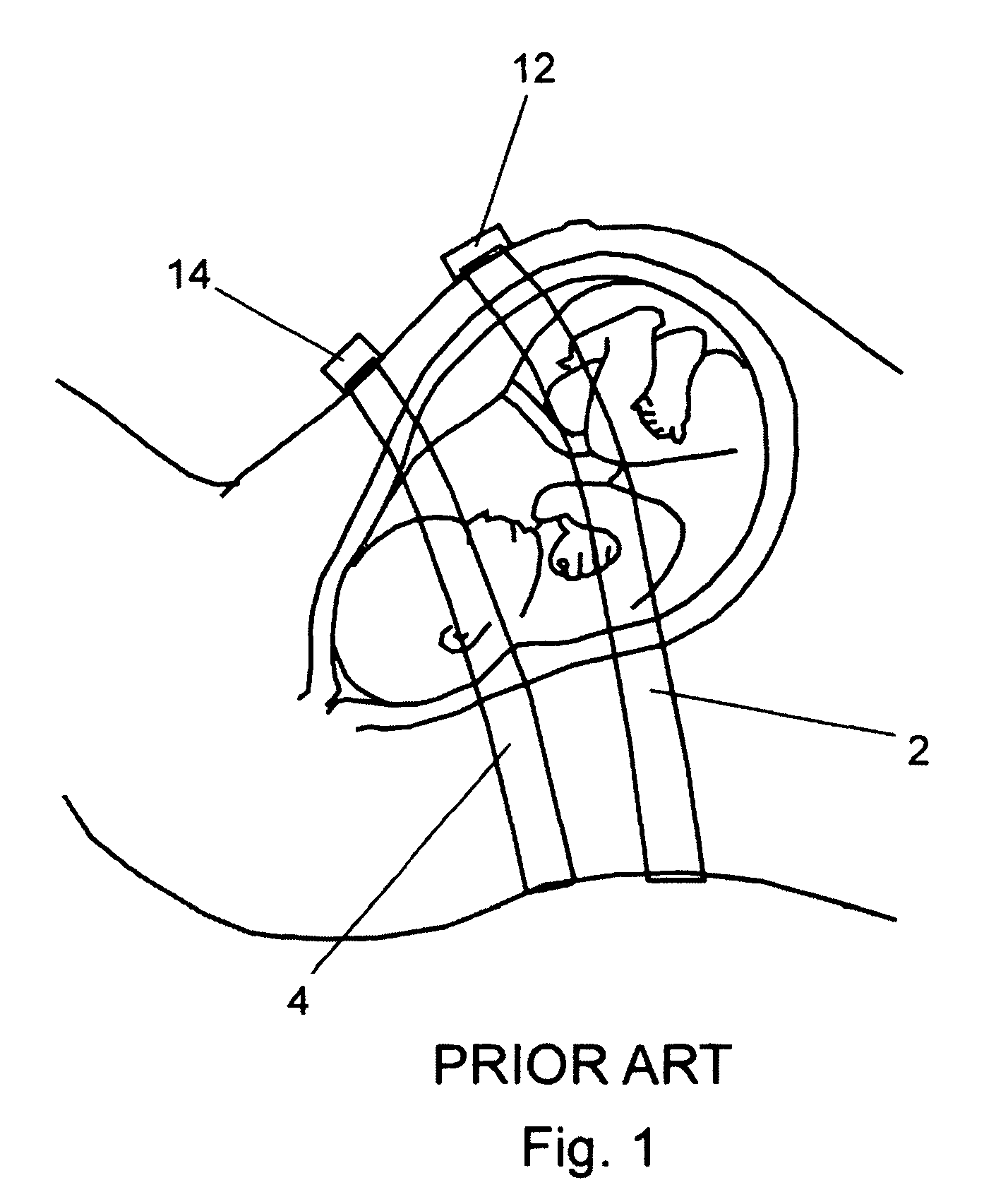 System, method, and kit for positioning a monitor transducer on a patient