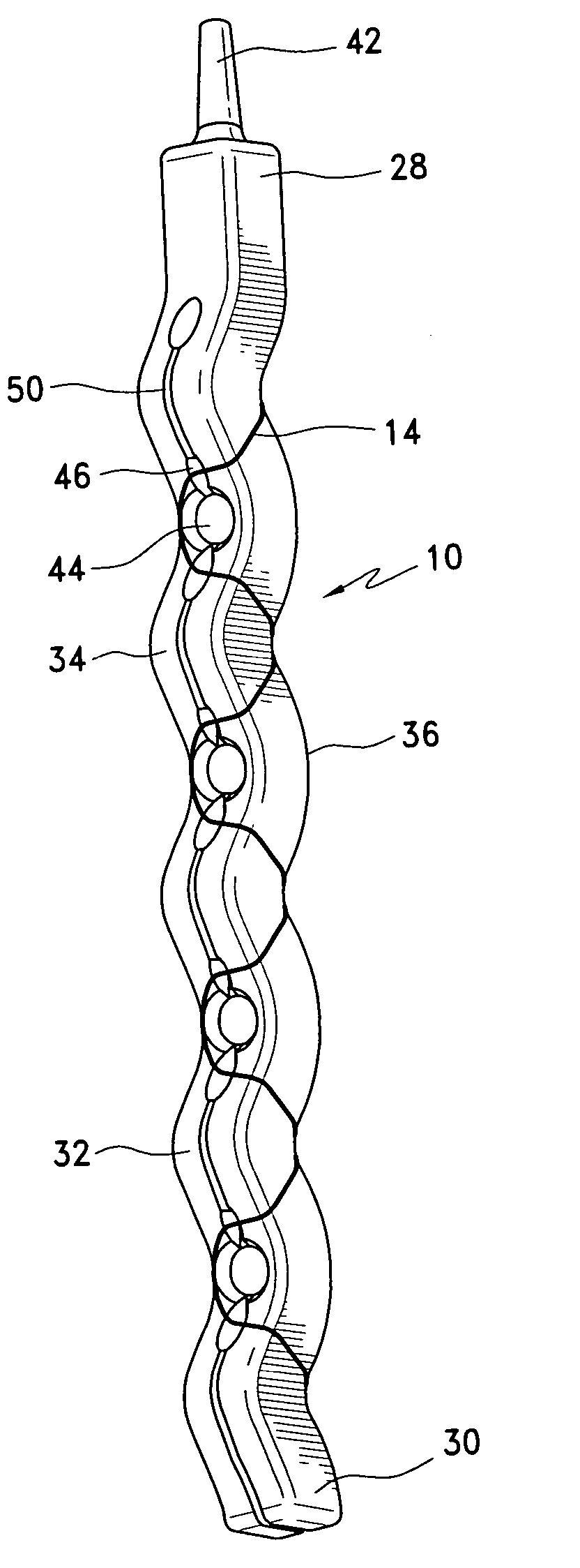 Apparatus for single pass gastric restriction