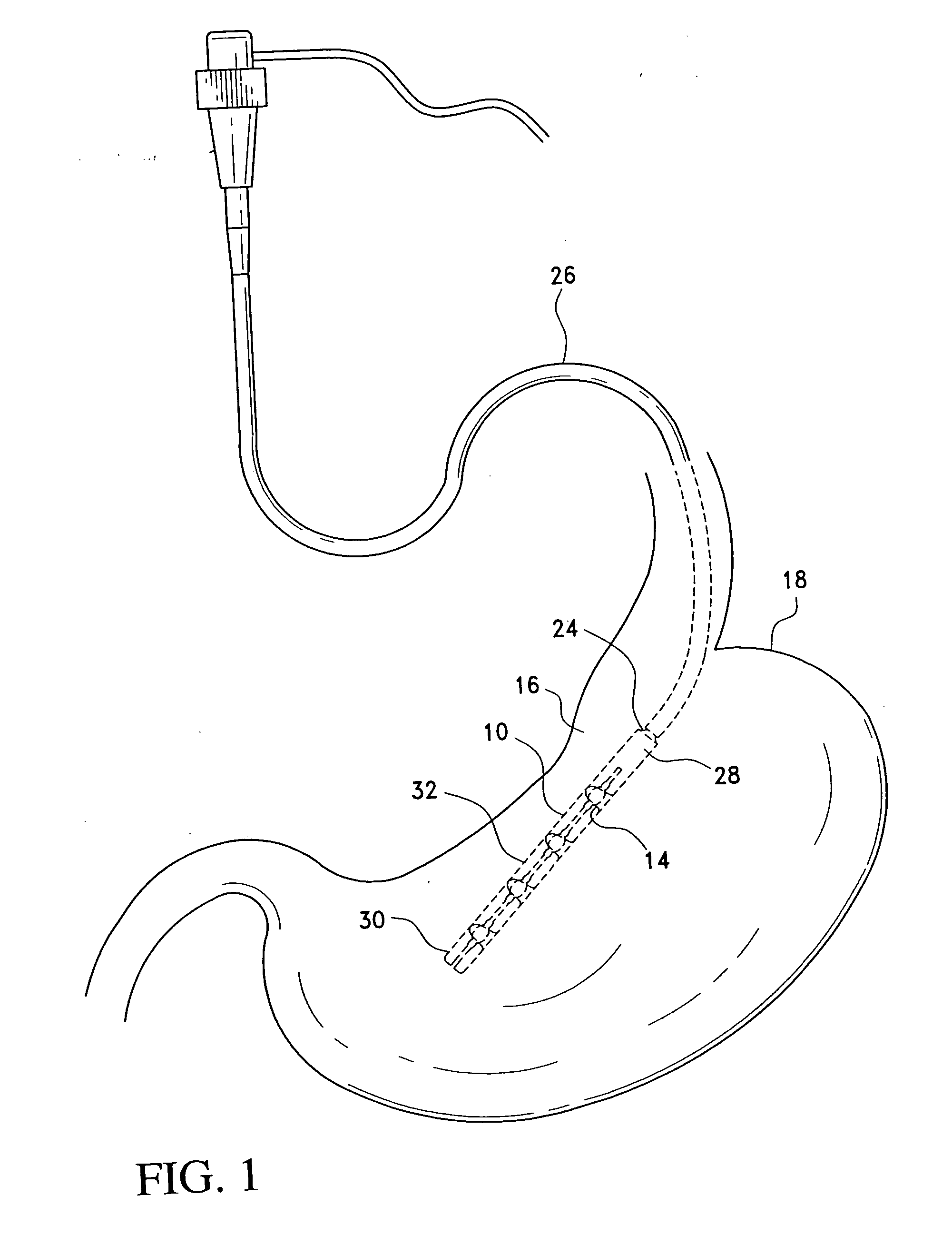 Apparatus for single pass gastric restriction