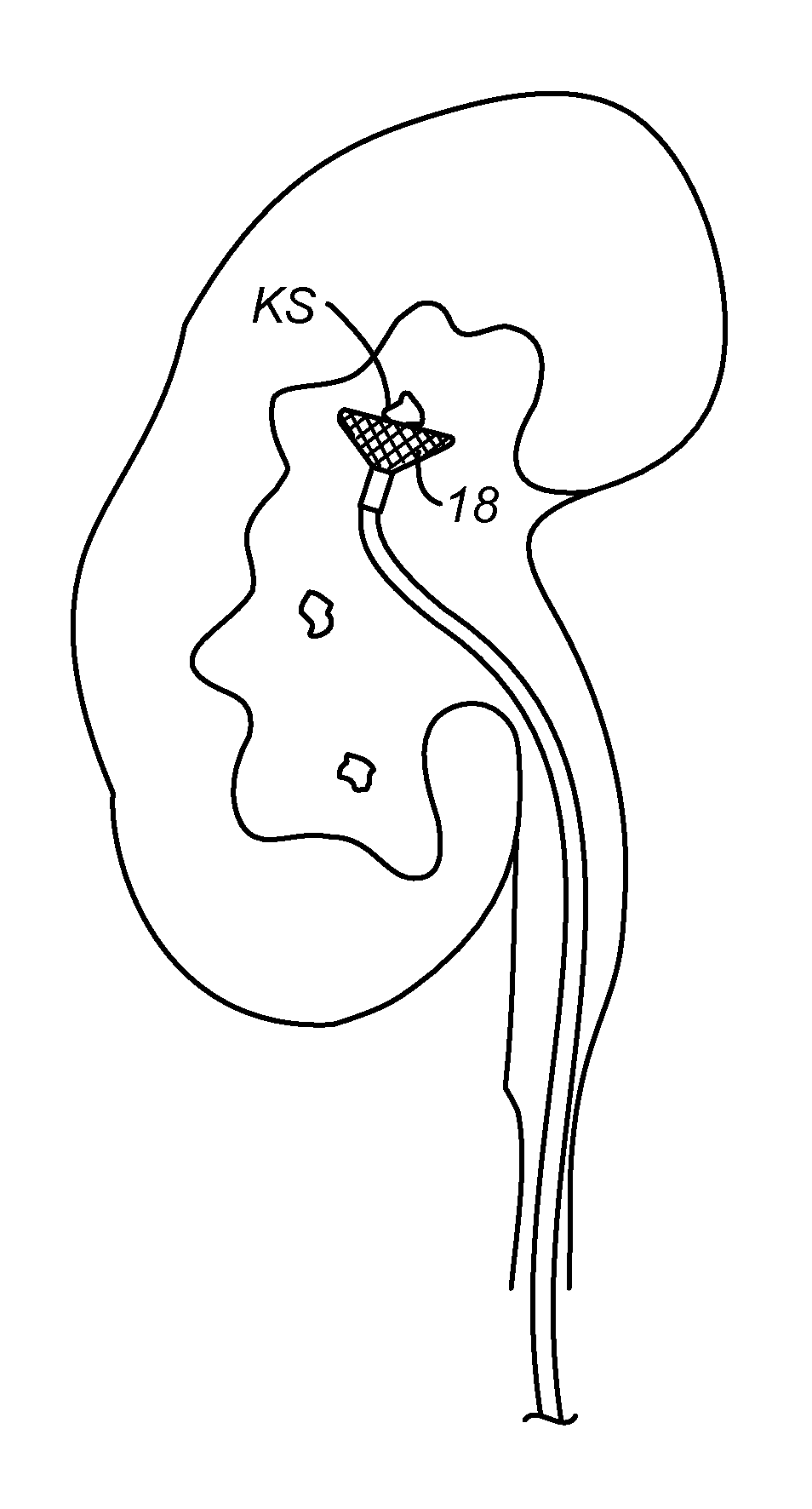 Methods and systems for capturing and removing urinary stones from body cavities