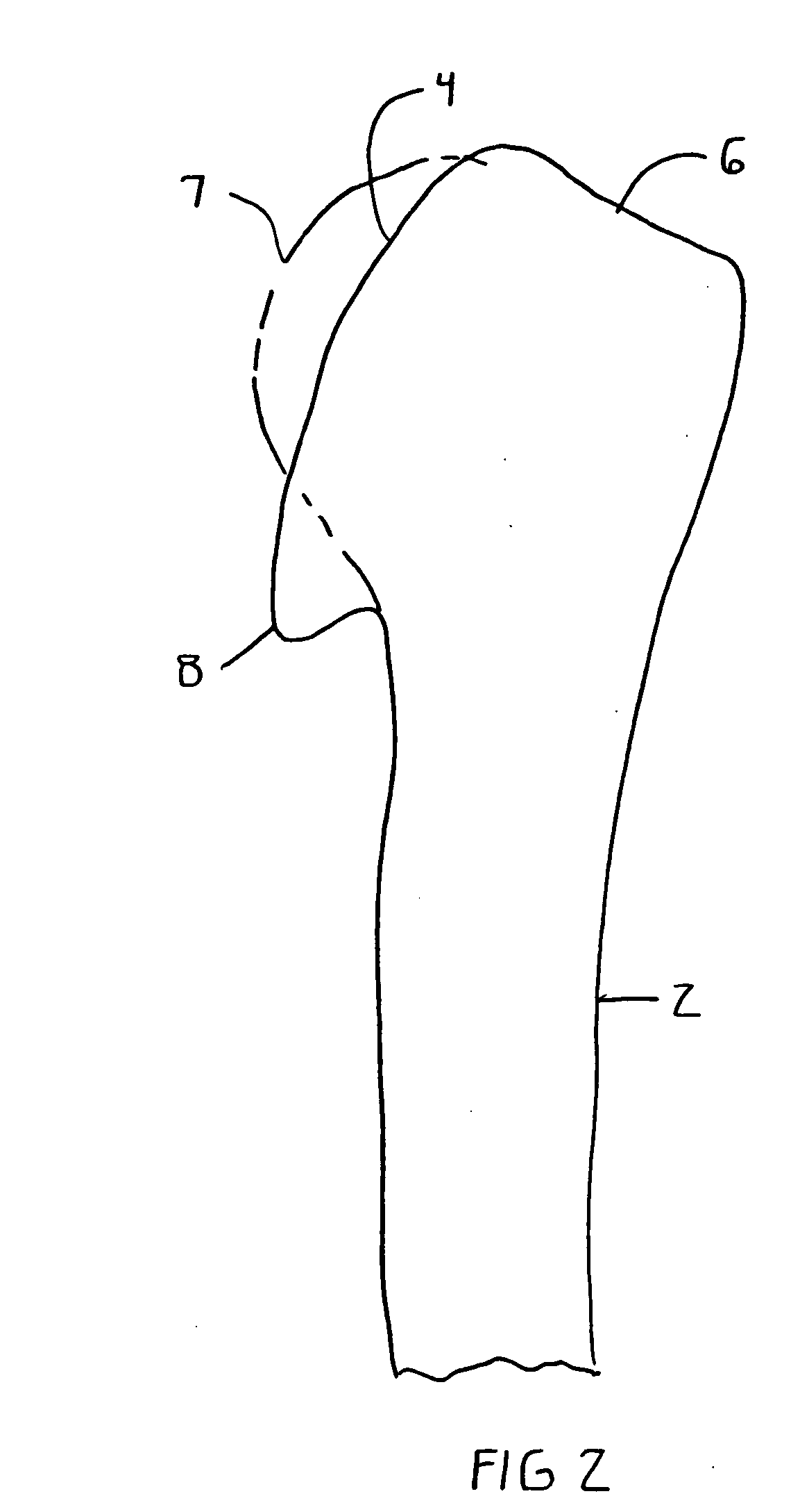 Surface replacement extractor device and associated method