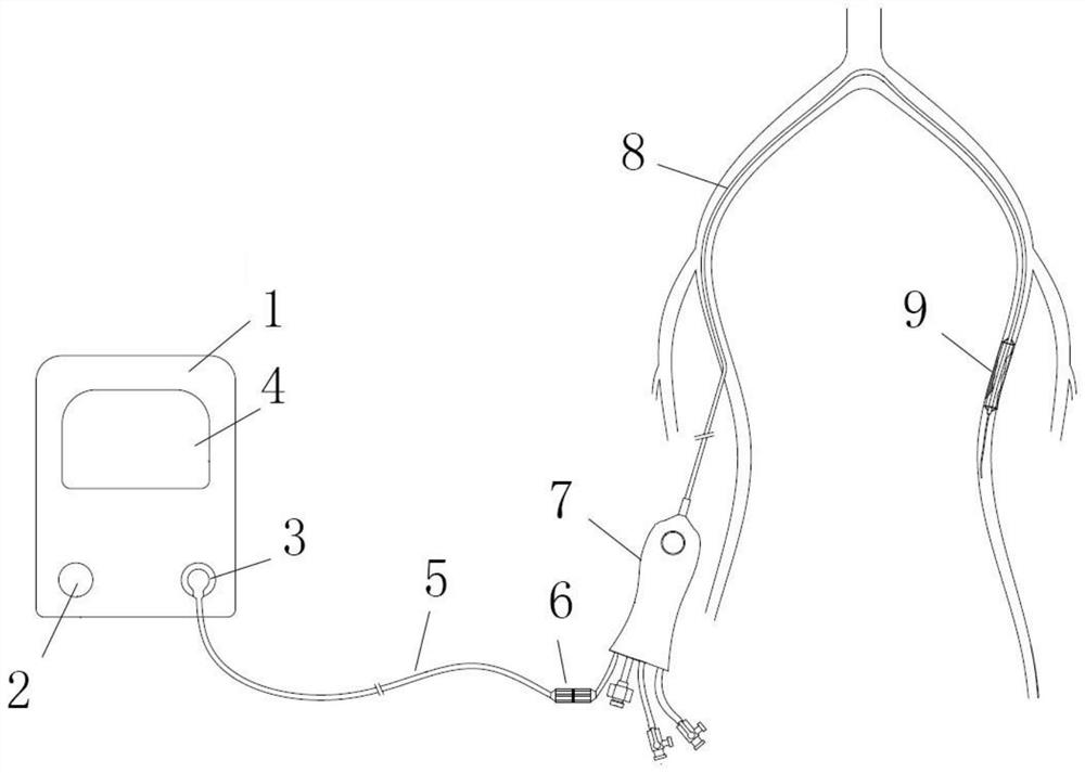 A high-pressure shock wave generation system for cardiovascular stenosis