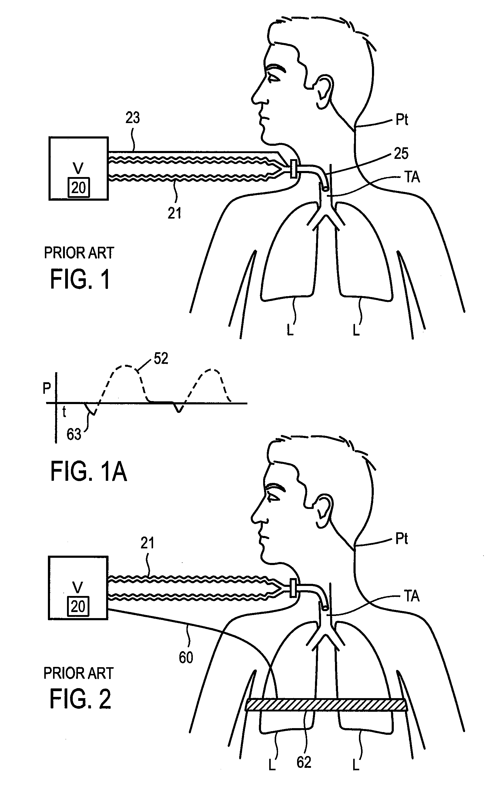 Methods and devices for sensing respiration and controlling ventilator functions