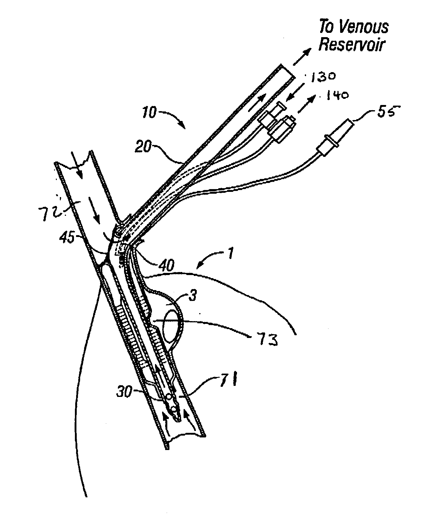 Cooling cannula system and method for use in cardiac surgery