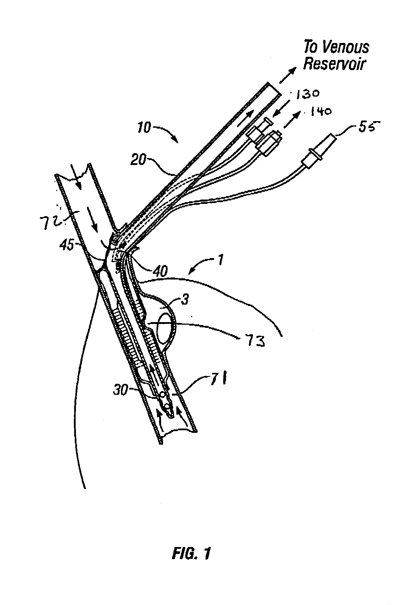 Cooling cannula system and method for use in cardiac surgery