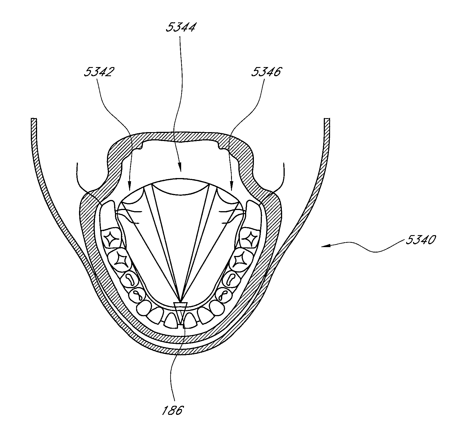 Methods and devices for the treatment of airway obstruction, sleep apnea and snoring
