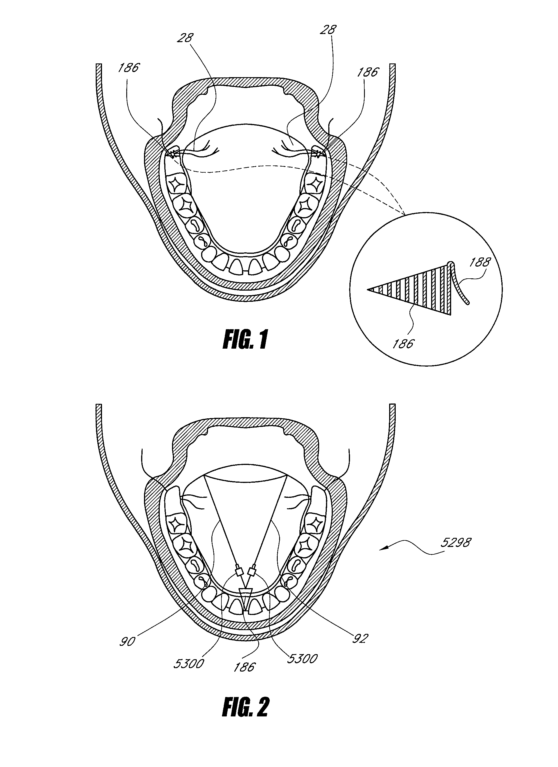 Methods and devices for the treatment of airway obstruction, sleep apnea and snoring
