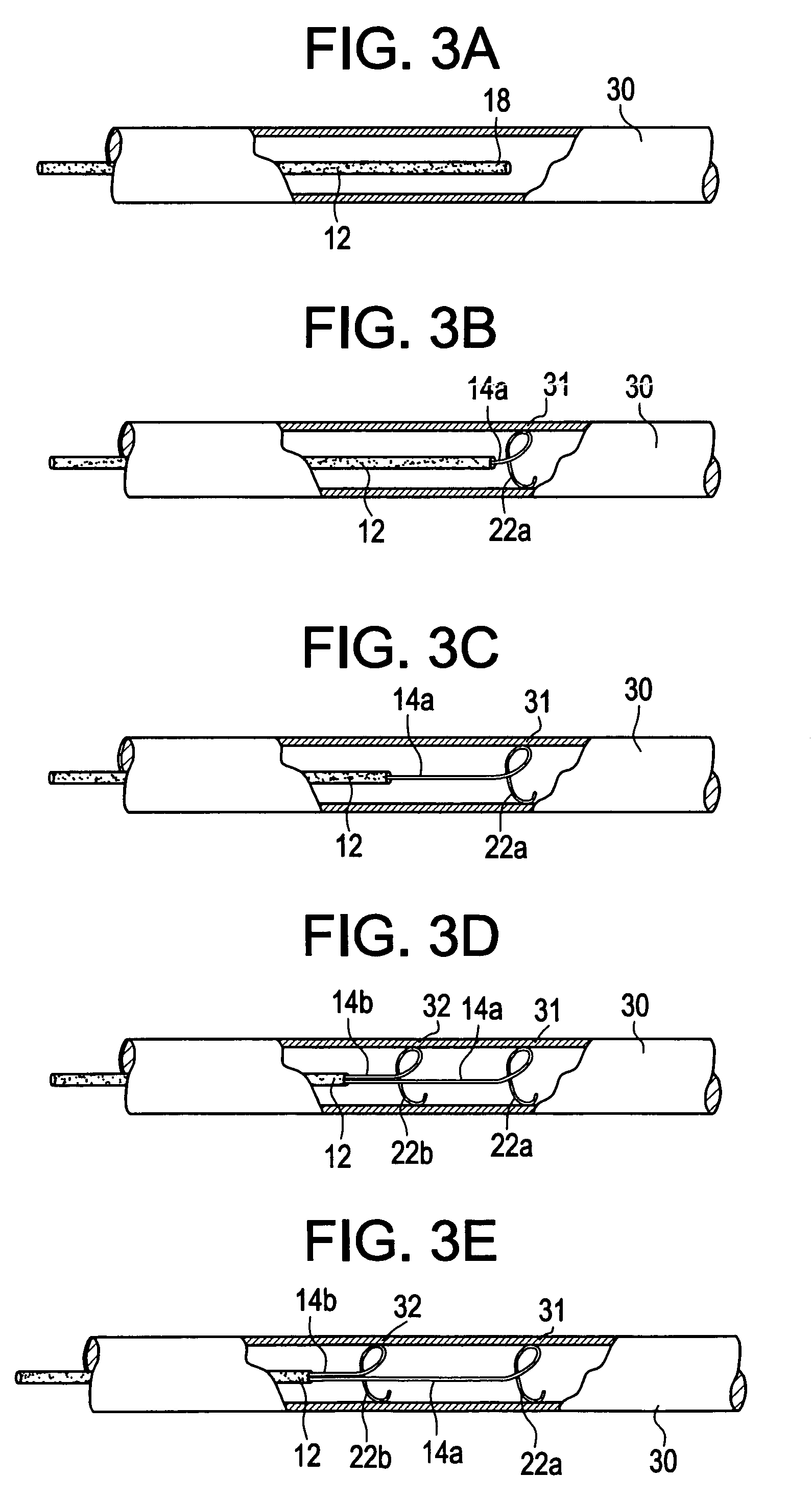 Intravascular device and method for axially stretching blood vessels