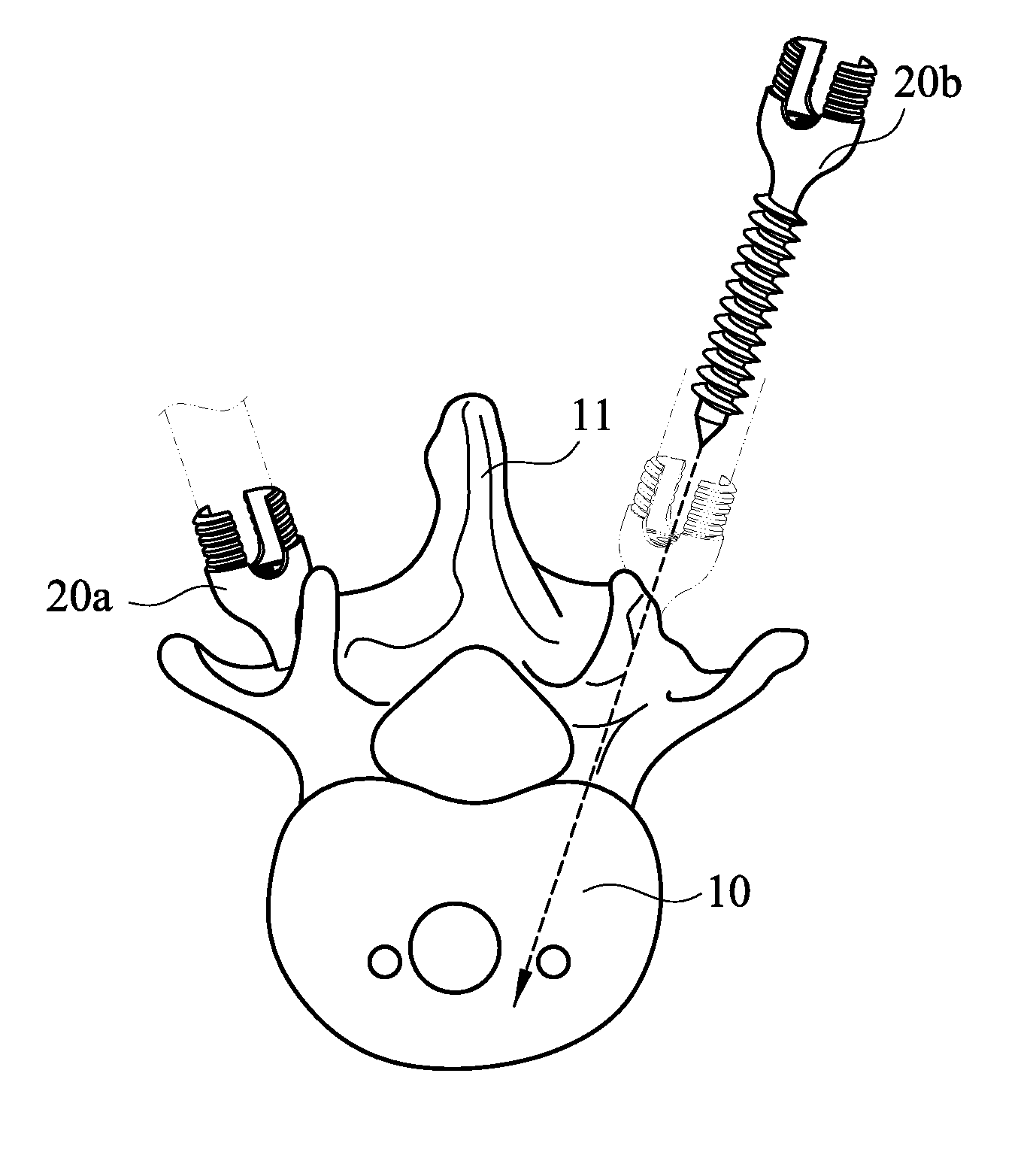 Method for guiding symmetric implantation of bone screws