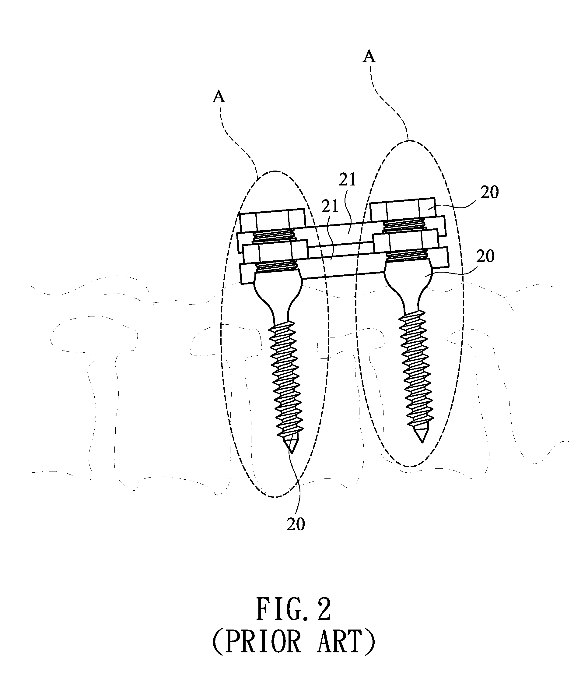 Method for guiding symmetric implantation of bone screws