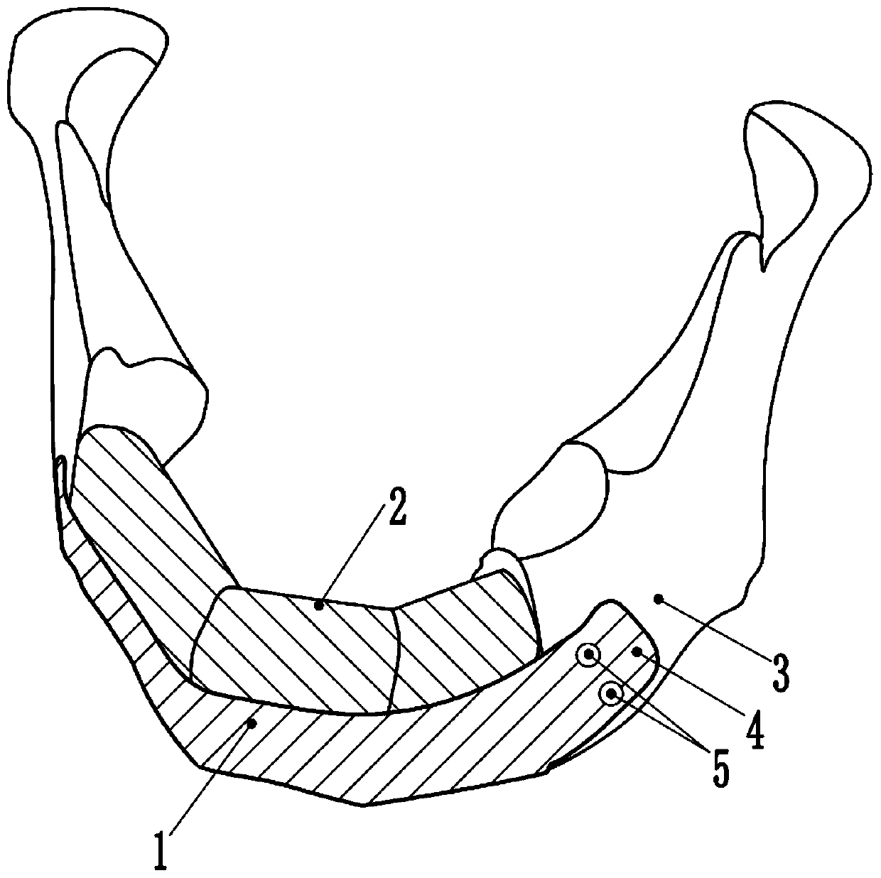 Personalized mandible substitute compounded with autologous bone