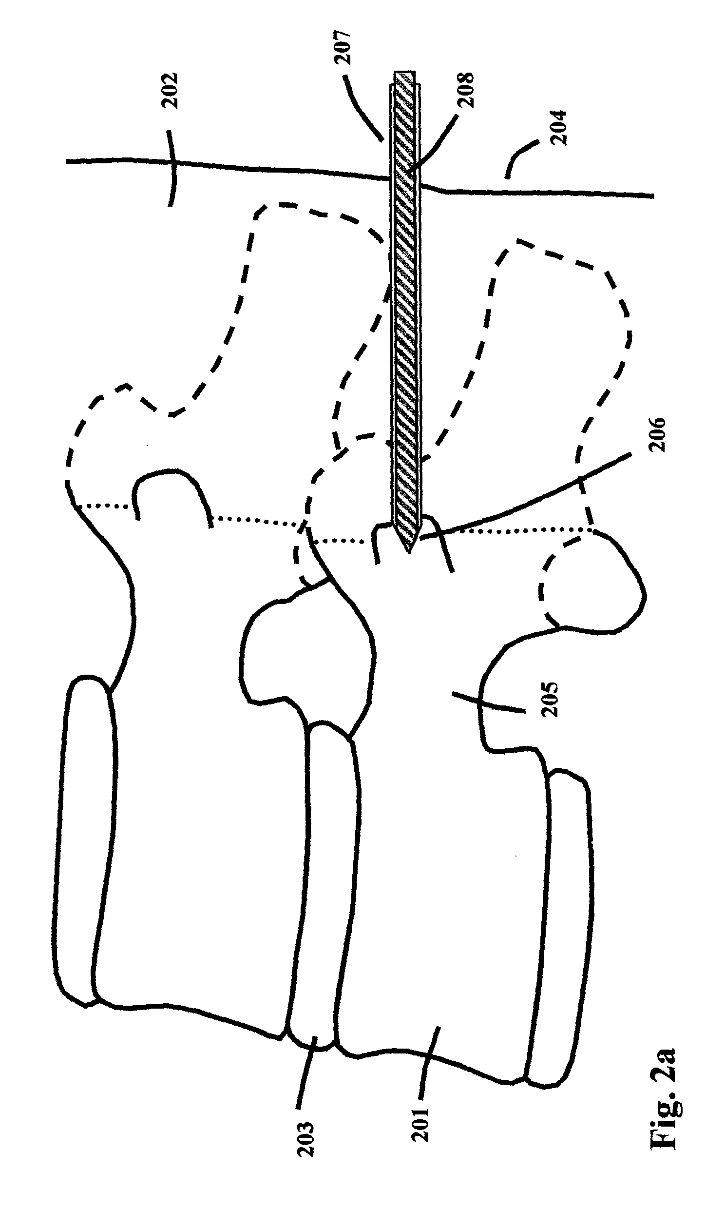 Method and Device for Restoring Spinal Disk Functions