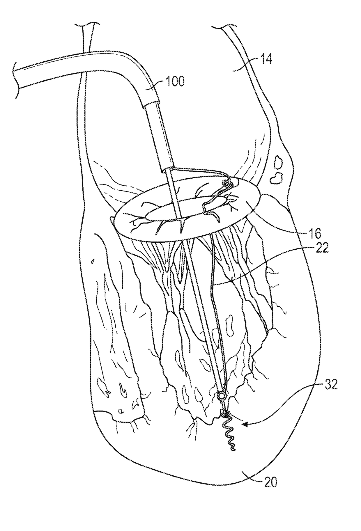 Apparatus for transvascular implantation of neo chordae tendinae