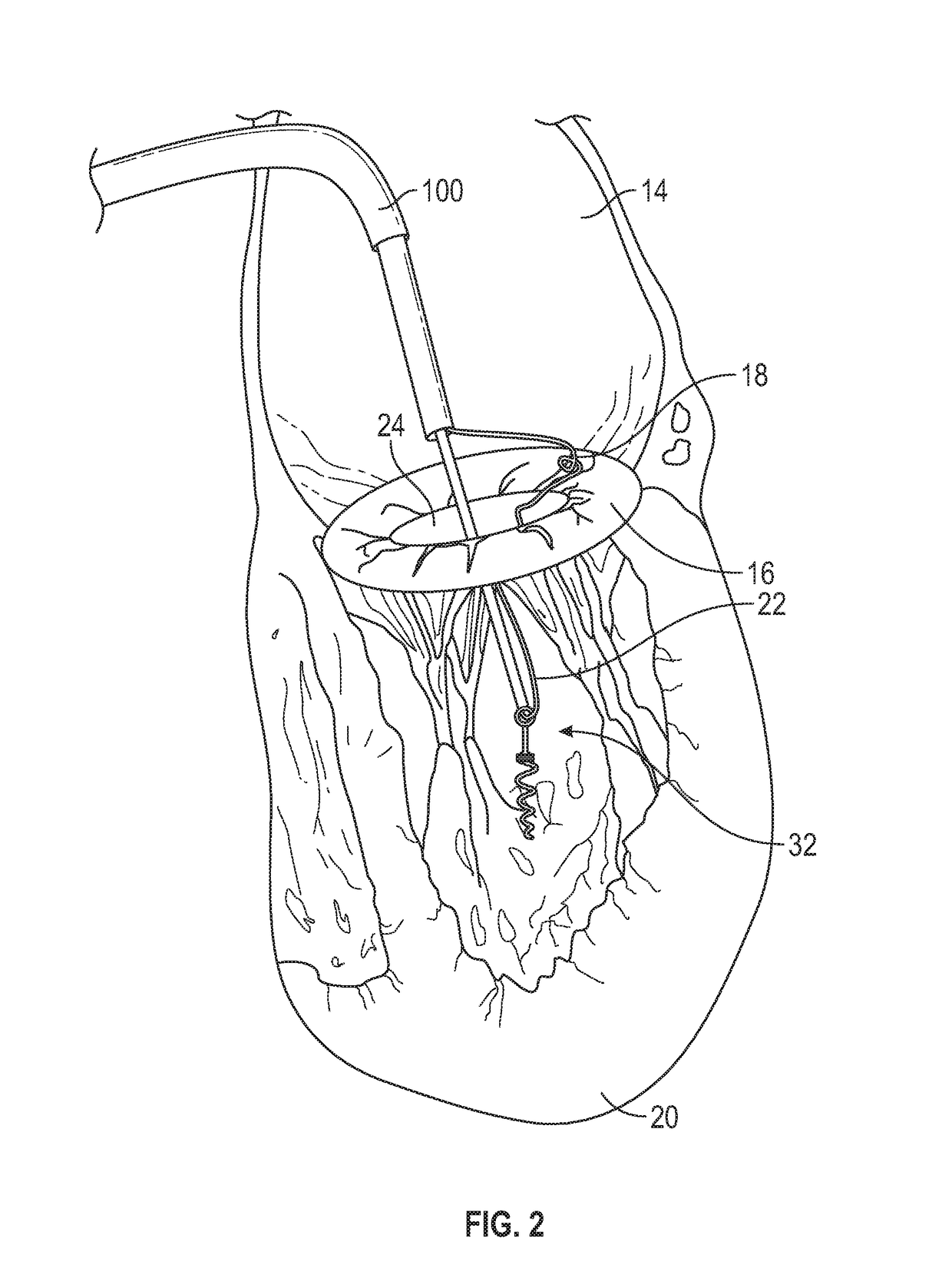 Apparatus for transvascular implantation of neo chordae tendinae