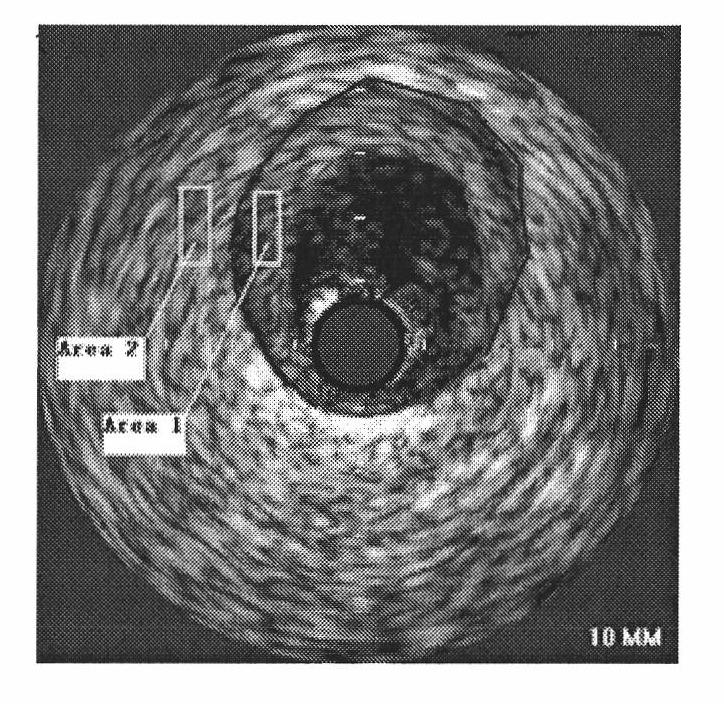 Automatic identifying method of artery plaque type based on ultrasonic image in blood vessel