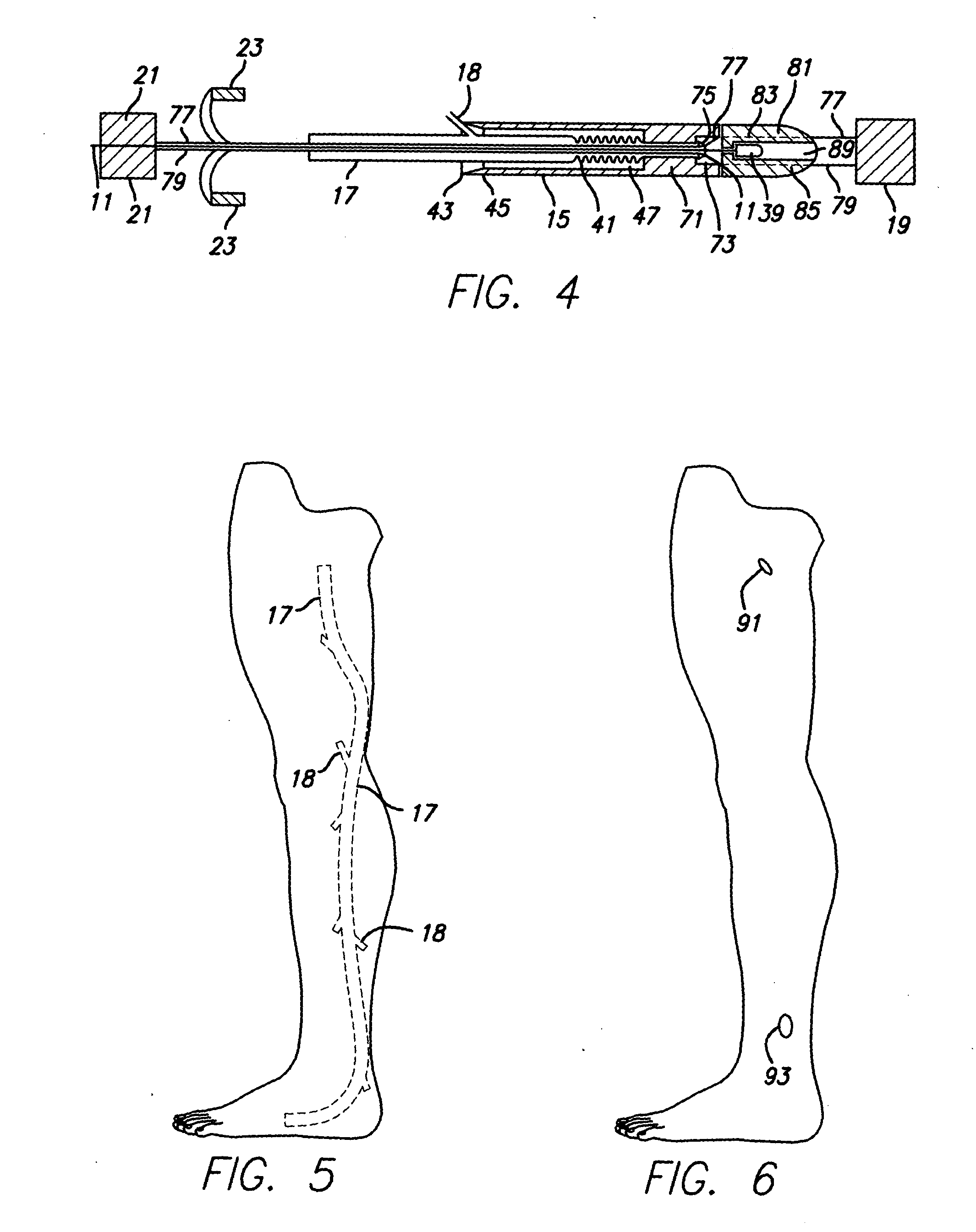 Method and apparatus for vessel harvesting