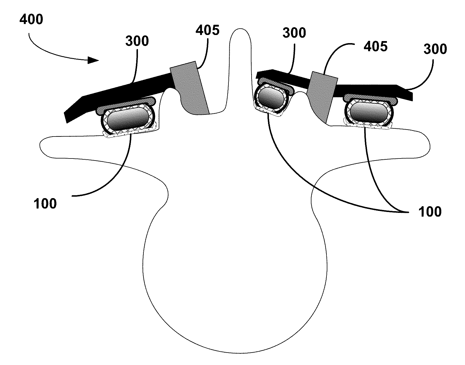 Multi-layer osteoinductive, osteogenic, and osteoconductive carrier