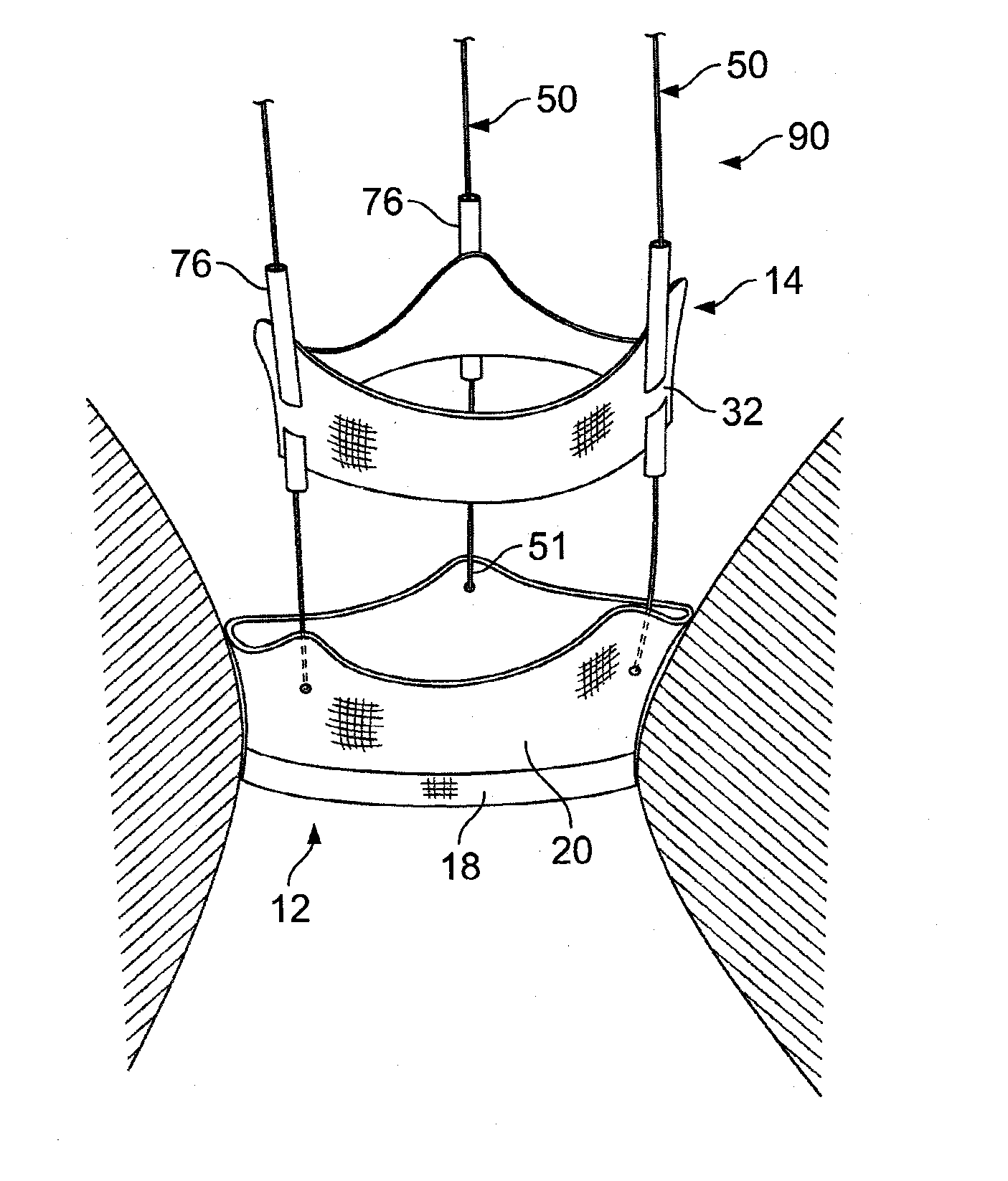 Foldable prostheses, multiple component prosthetic heart valve assemblies, and apparatus and methods for delivering them