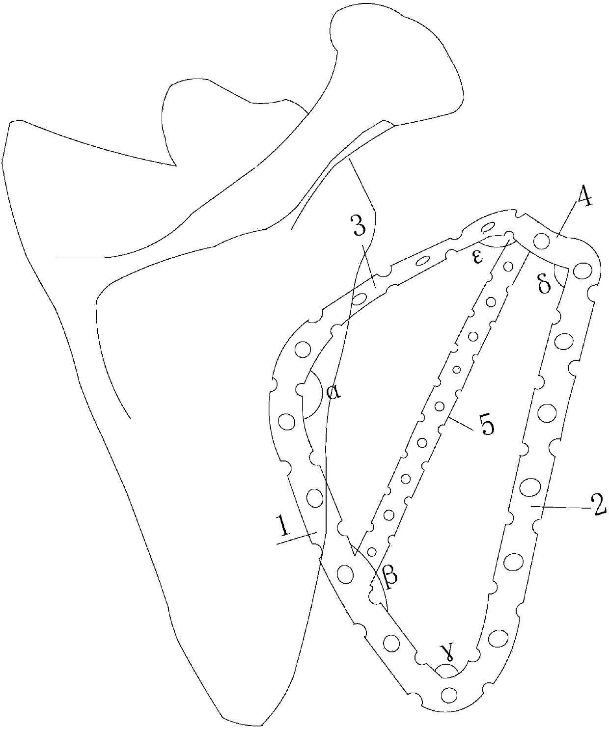 An anatomical plate for complex scapular body fractures