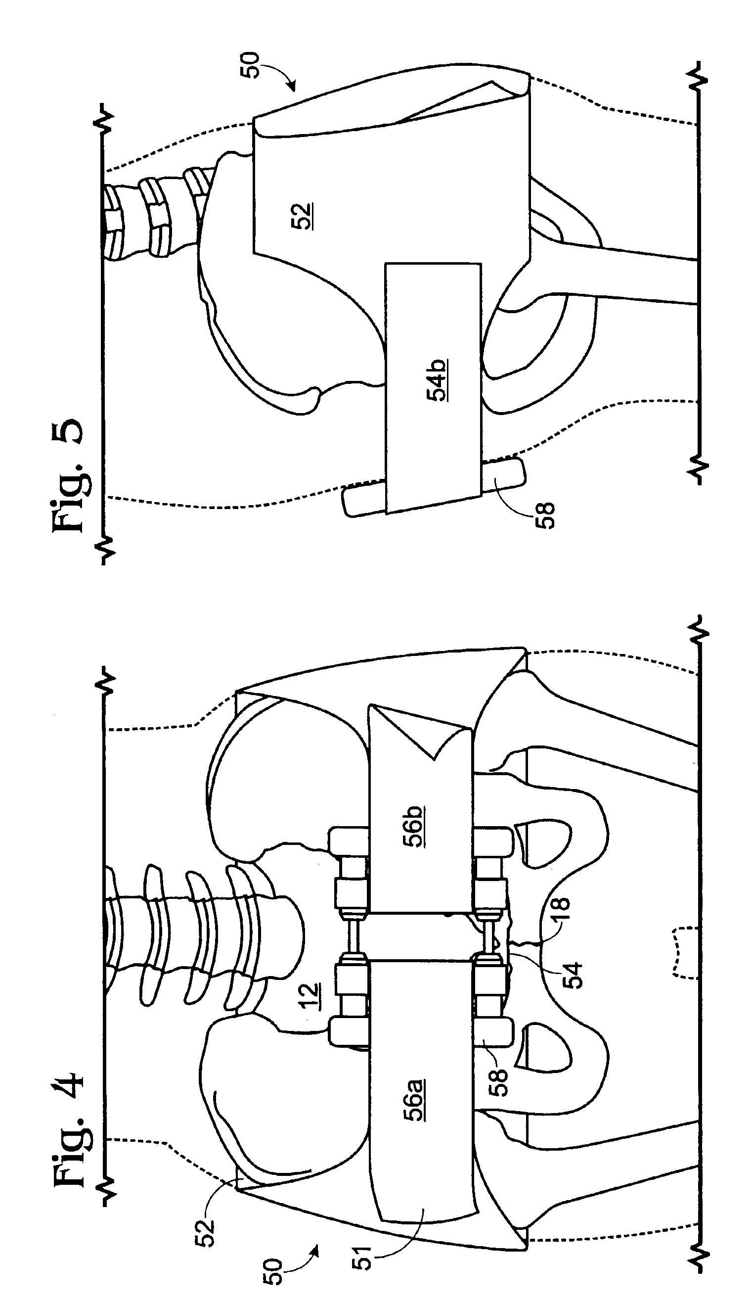Apparatus and method for stabilizing pelvic ring disruption