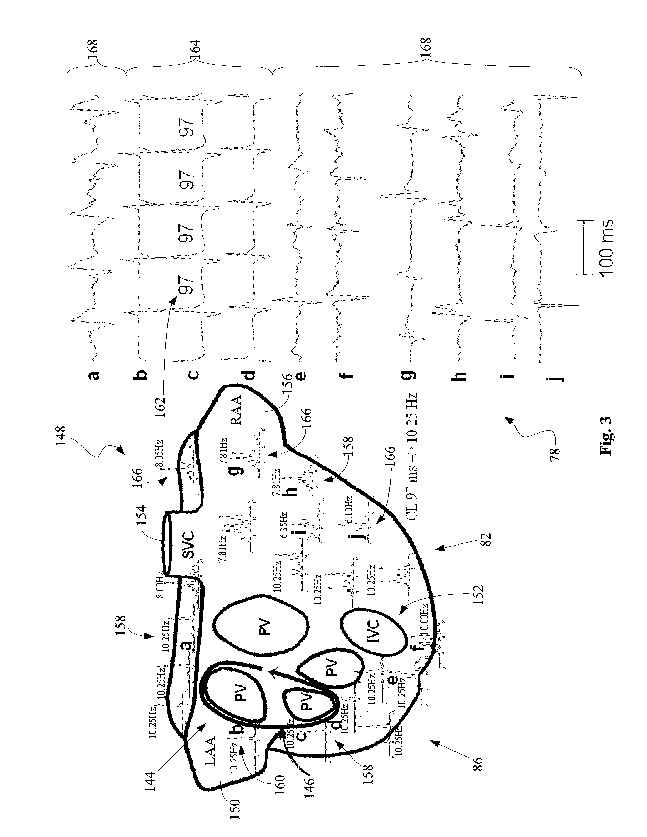 System and related methods for identifying a fibrillation driver