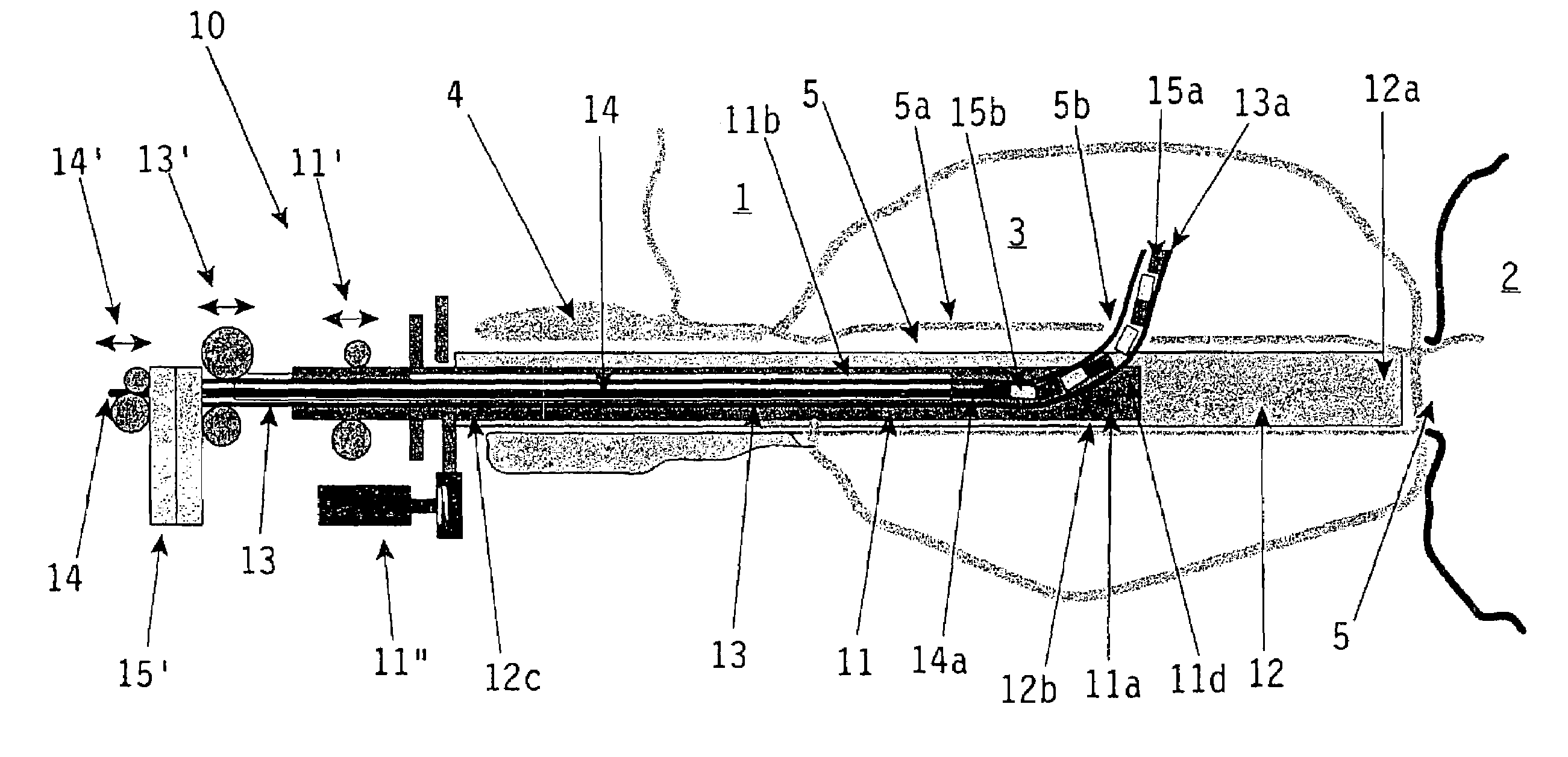 Urethral prove device for effecting radiation treatment