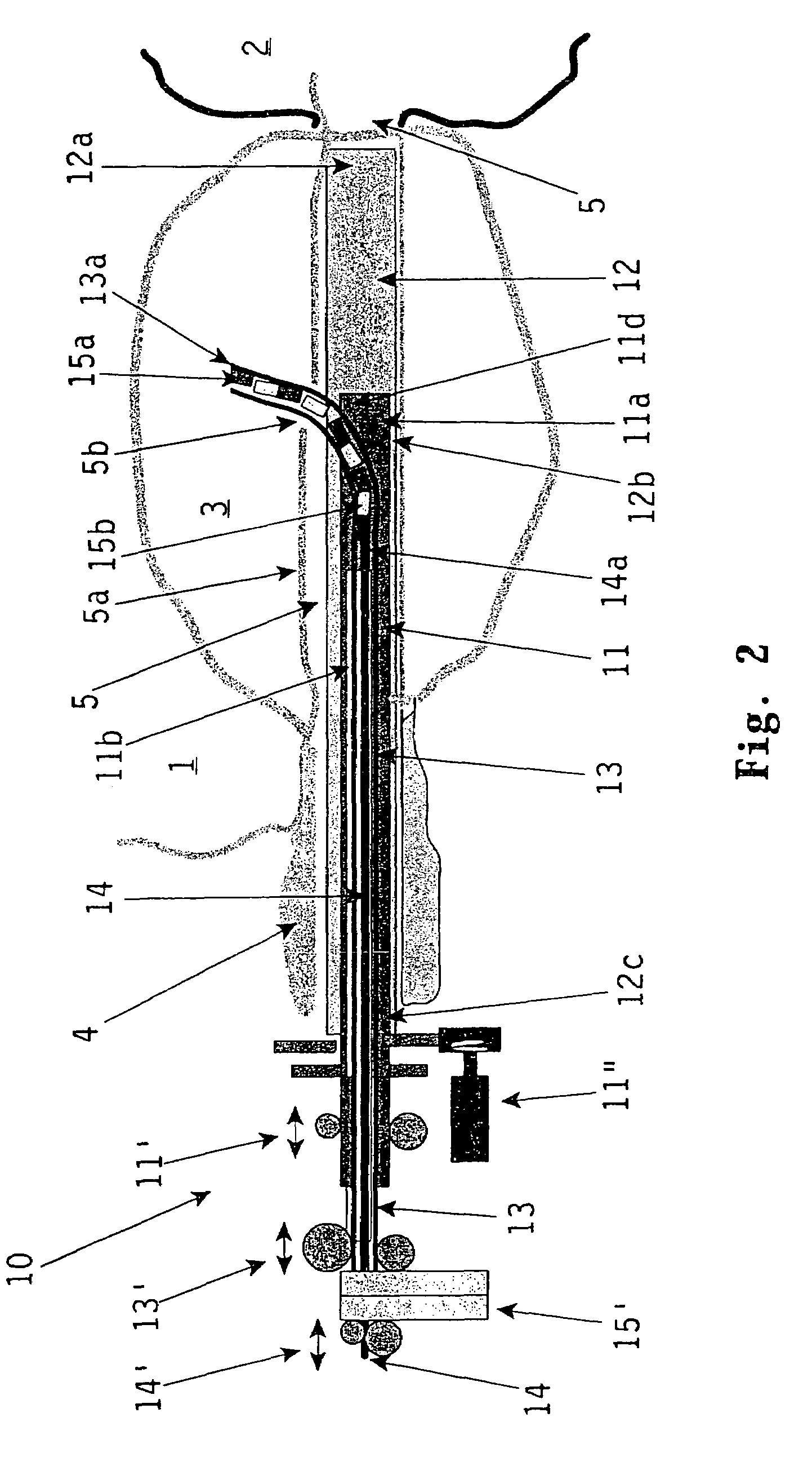 Urethral prove device for effecting radiation treatment