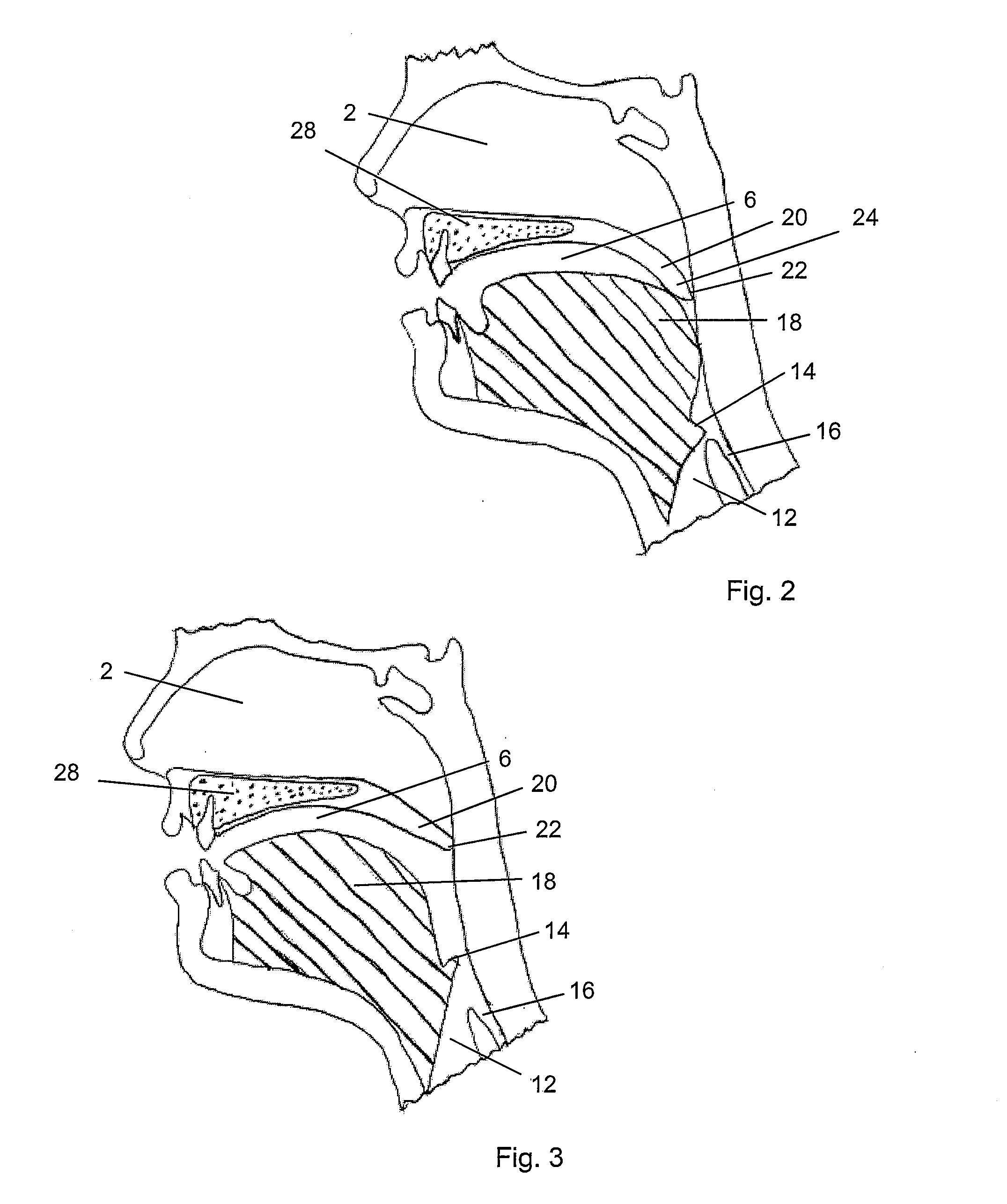Method and apparatus for creating variable stiffness and/or reduction of soft tissue