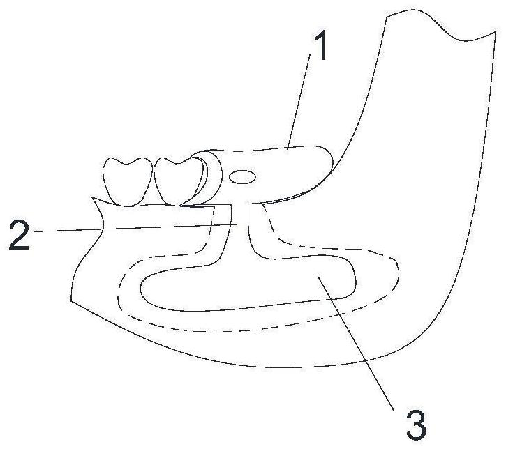 3D printing step-back type jaw cyst plugging treatment device and preparation method thereof