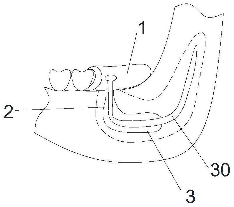 3D printing step-back type jaw cyst plugging treatment device and preparation method thereof