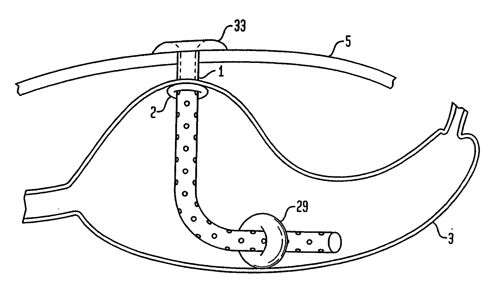 Apparatus for treating obesity by extracting food