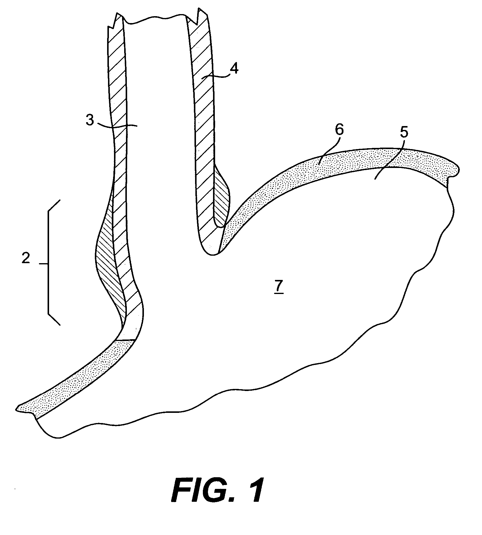 Devices and methods for tissue invagination