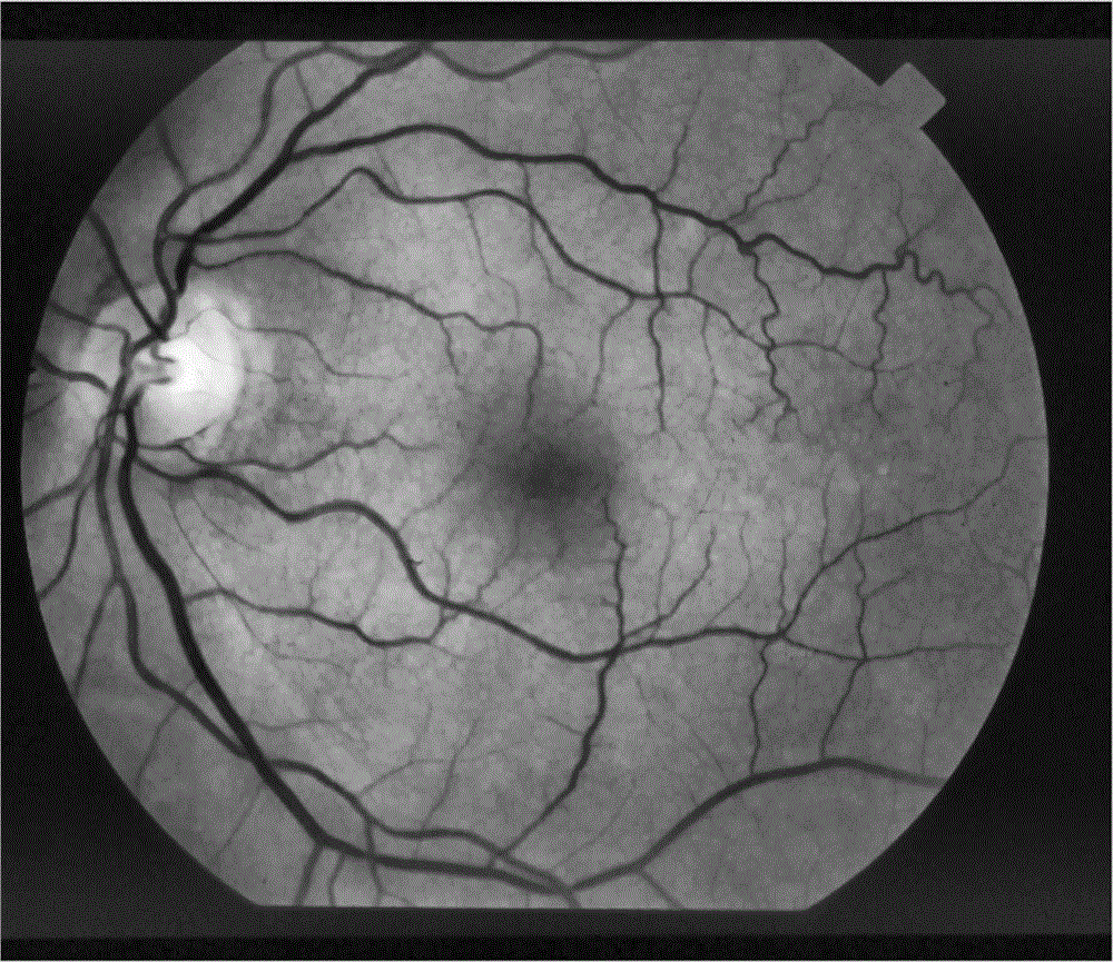 Retinal fundus image preprocessing method