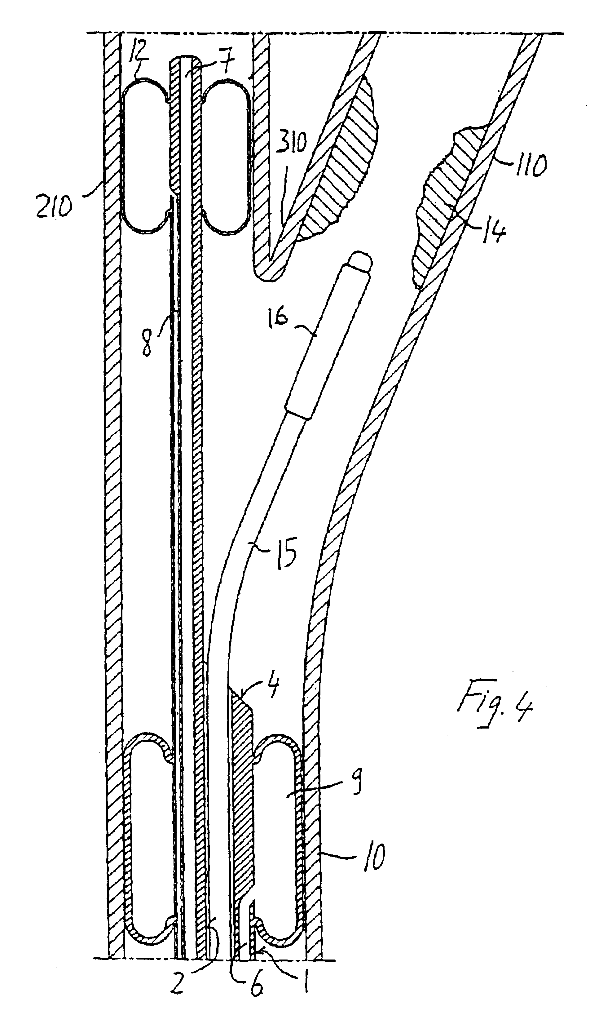Endovascular system for the treatment of stenoses of the carotid and catheter for this system