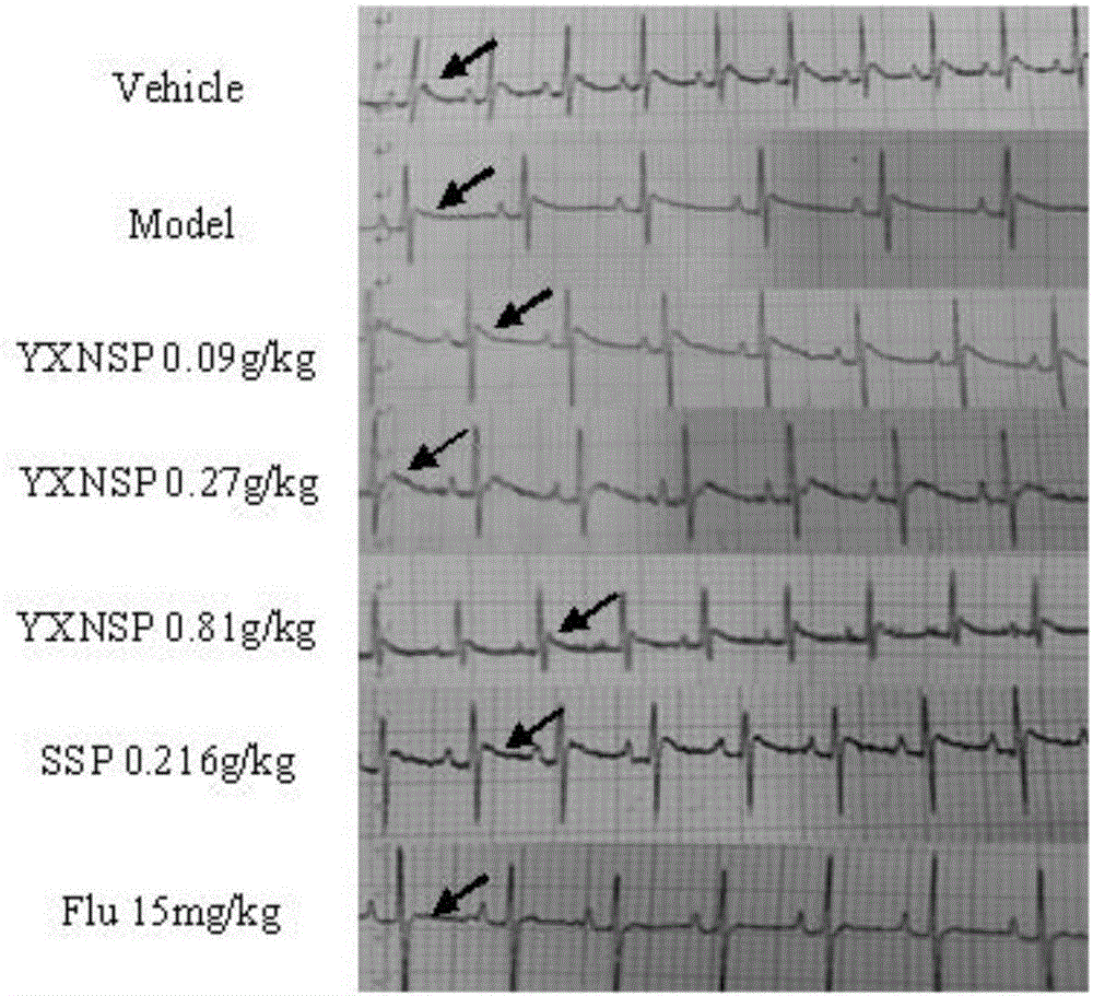 Application of mental stress relieving tablet in preparation of medicine for treating psychological heart disease