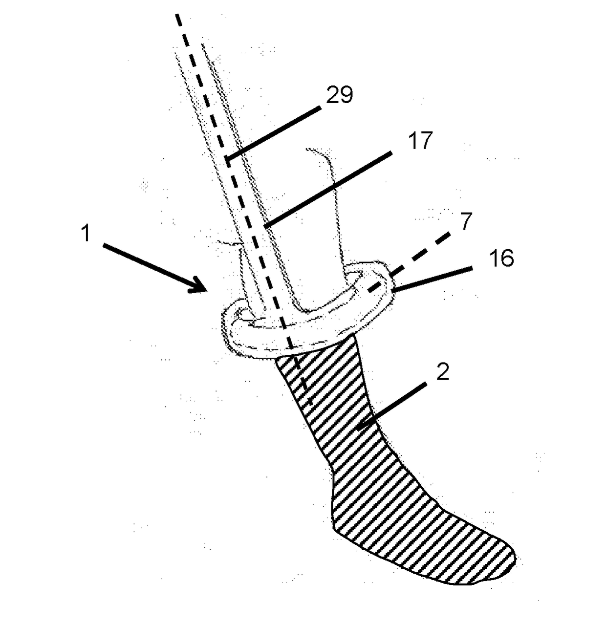 A putting-on aid for a support stocking