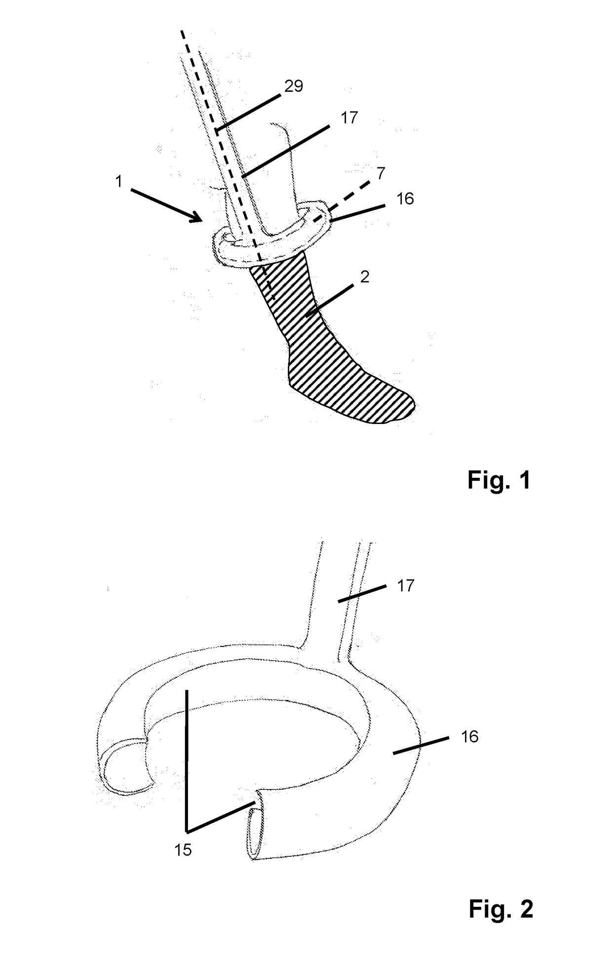 A putting-on aid for a support stocking