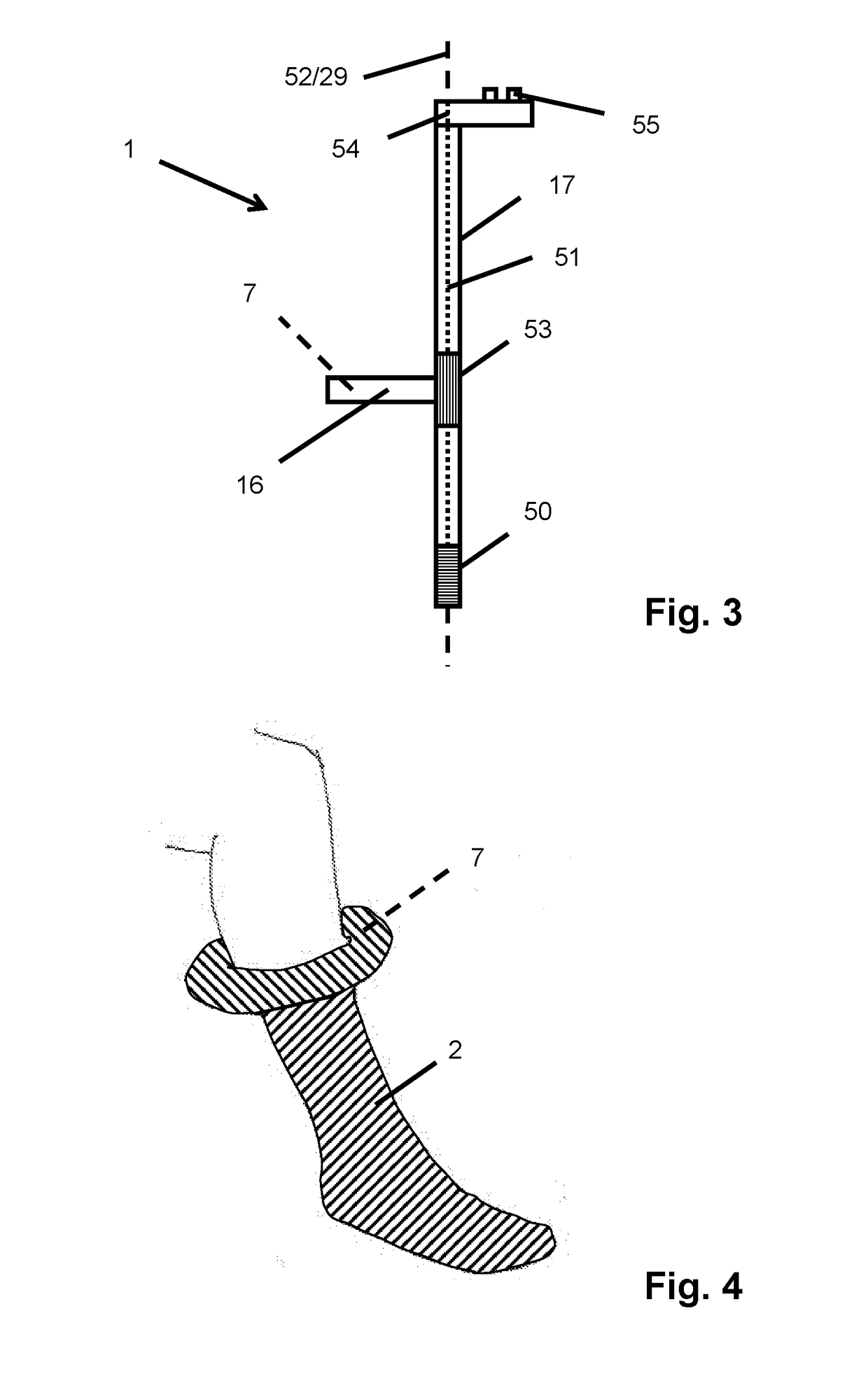 A putting-on aid for a support stocking