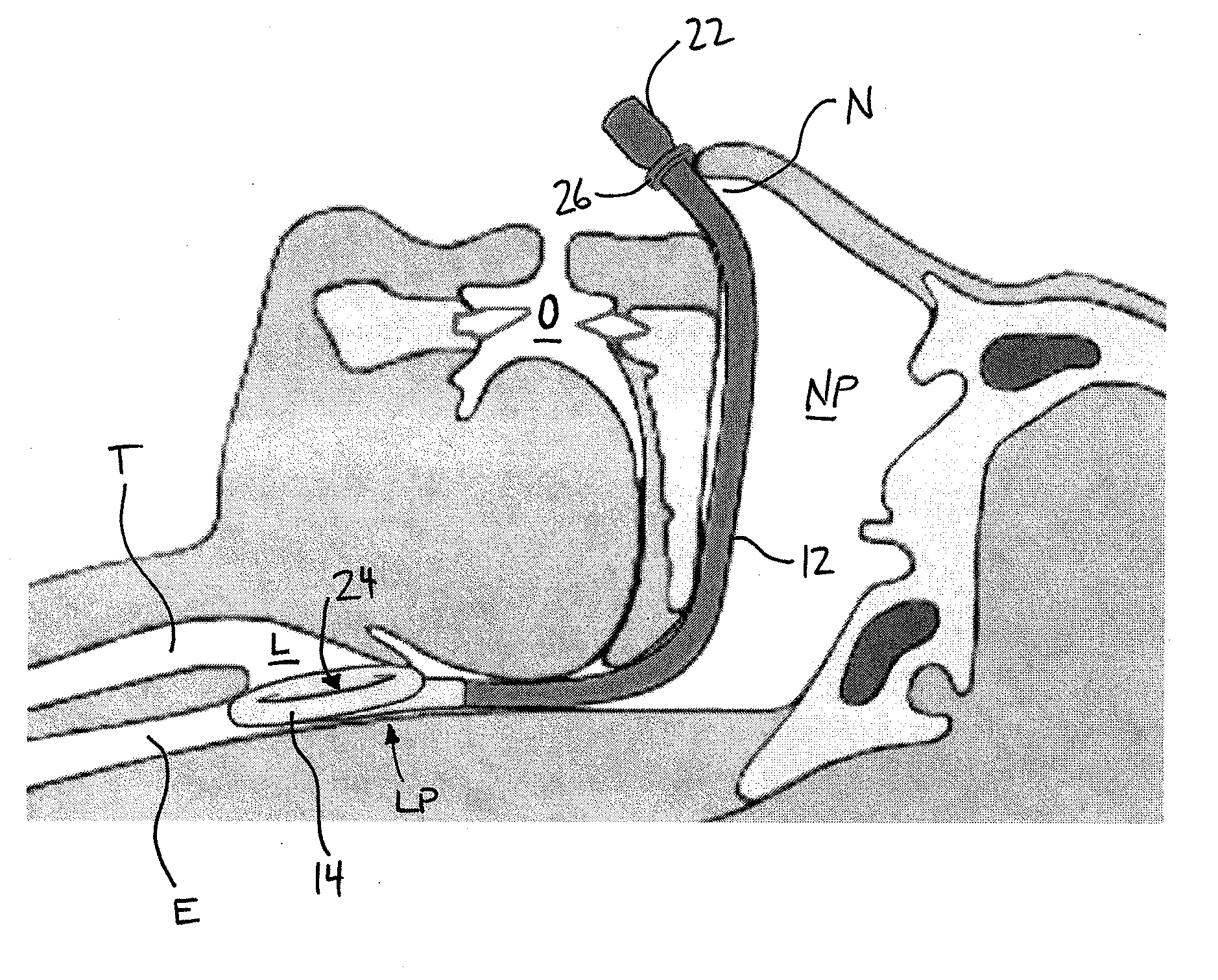 Nasal airway management device with inflatable supraglottic laryngeal cuff