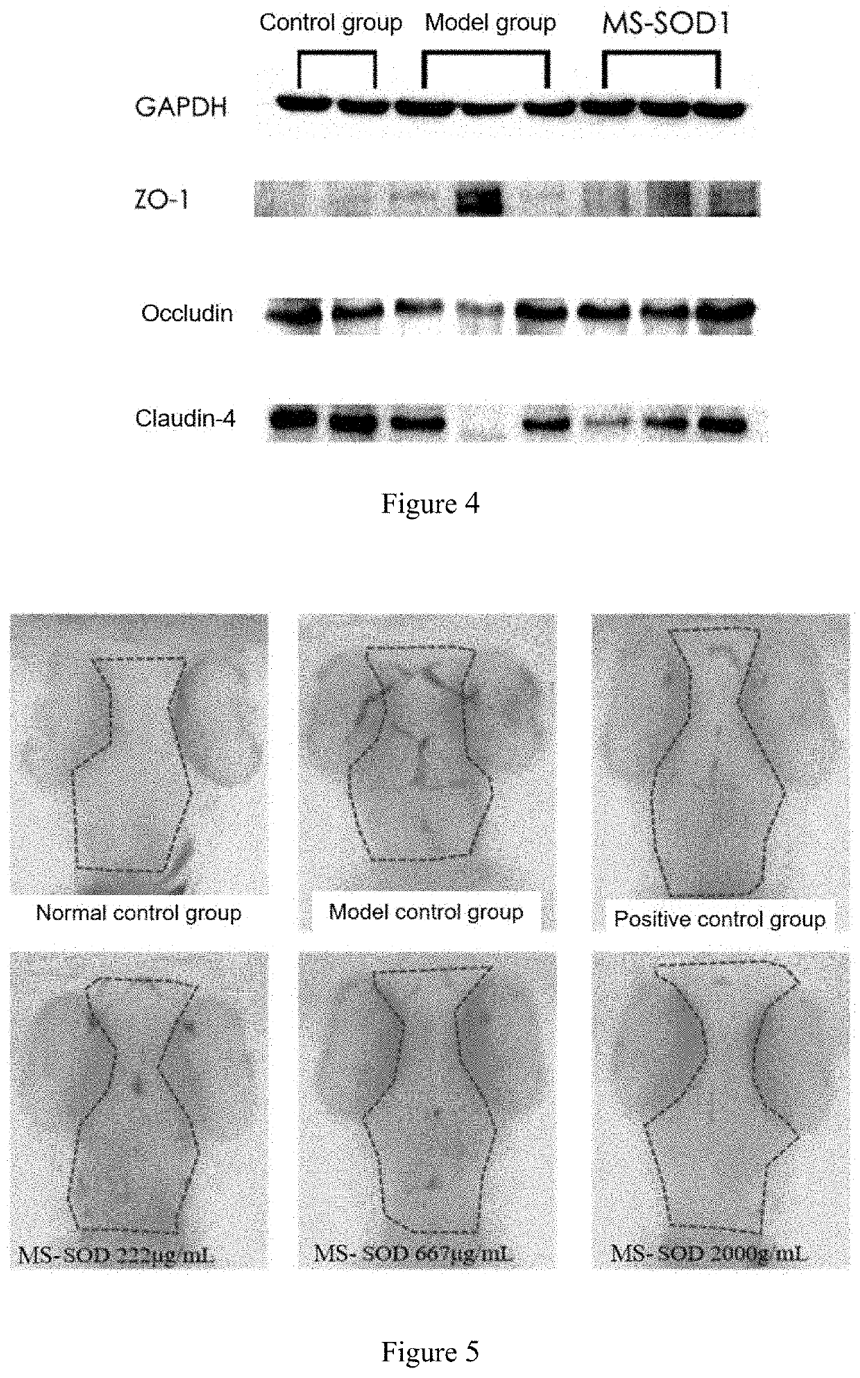 Use of a manganese superoxide dismutase with high stability in the prevention or treatment of cerebral stroke