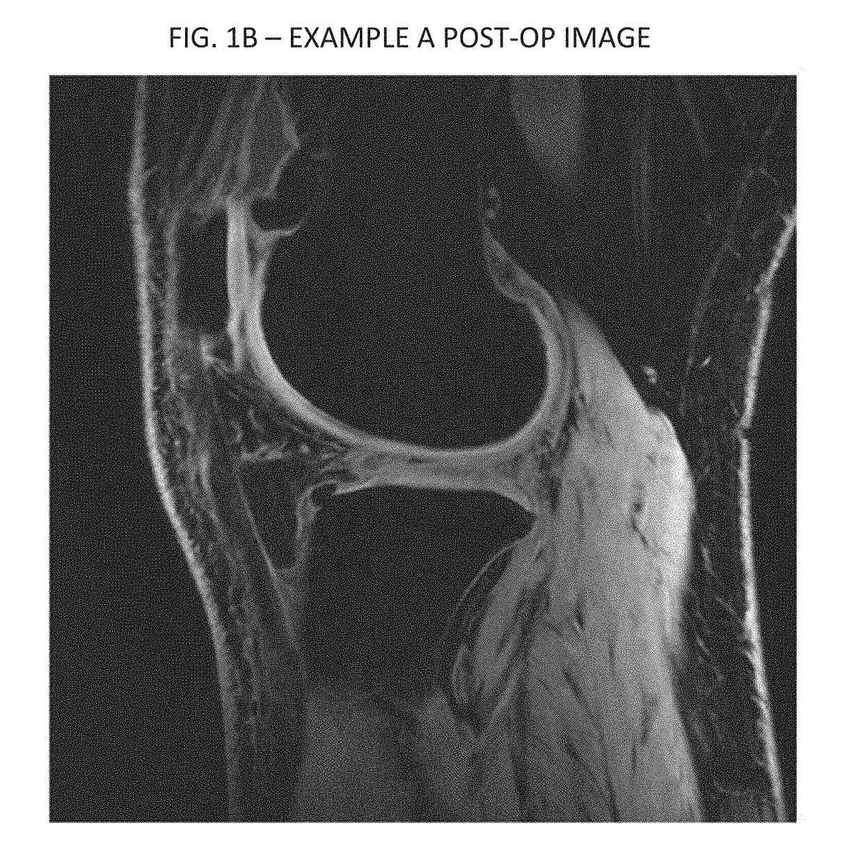 Cartilage repair, preservation and growth by stimulation of bone-chondral interface and delivery system and methods therefor