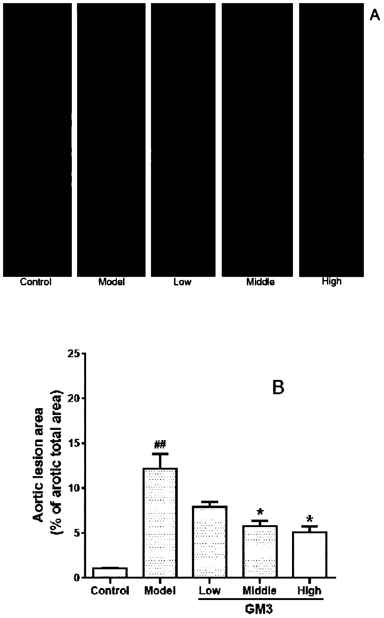 Application of ganglioside GM3 in preparation of medicine for treating atherosclerosis